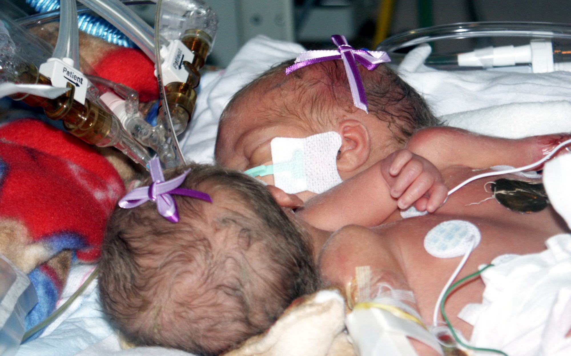 LACKLAND AIR FORCE BASE, Texas -- Conjoined twins Brynleigh (top) and Victoria Smith were born July 25 at Wilford Hall Medical Center here.  They remain in the center's neonatal intensive care unit on ventilator support under constant observation.  (U.S. Air Force photo by 2nd Lt. Benjamin Silva)