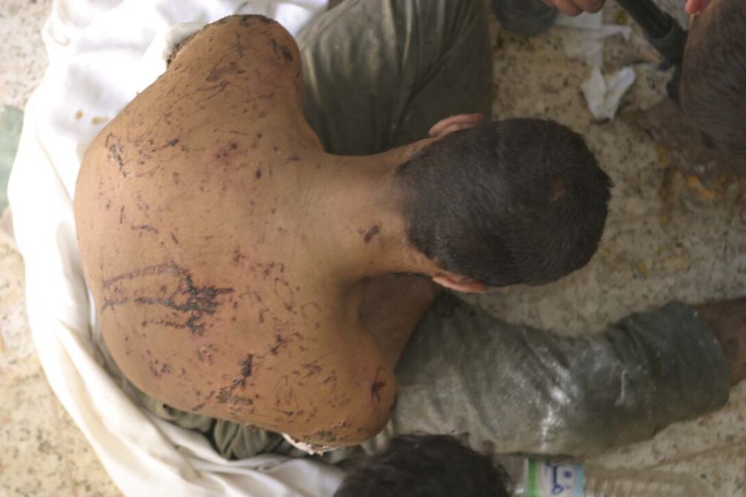 KARABILAH, Iraq (June 18, 2005)-  An Iraqi man, who was held captive and beaten, had welts and lacerations across his back and arms from being tortured with electricity. This man and three others were rescued by Iraqi Security Forces and Marines from 3rd Battalion, 2nd Marine Regiment who discover an insurgent torture chamber in the city of Karabilah, Iraq during Operation Romhe. The Marines had entered a building which they believed to be a car bomb factory finding these men. The man was hung by his feet, head dipped in water and then tortured with electric shock. The four Iraqis received immediate first aid and were transported to a medical facility for further treatment and recovery.  Operation Romhe's mission is to destroy strong points held by insurgents in the city of Karabilah. The Marines of 2nd Marine Division conduct counter-insurgency operations with Iraqi Security Forces to isolate and neutralize Anti-Iraqi Forces, to support the continued development of Iraqi Security Forces, and to support Iraqi reconstruction and democratic elections in order to create a secure environment that enables Iraqi self-reliance and self-governance. (Official USMC Photo by Cpl Neill A. Sevelius)