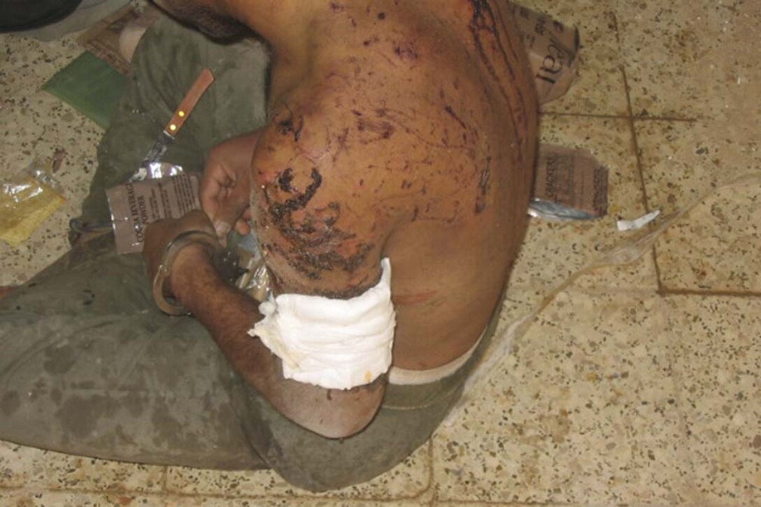 KARABILAH, Iraq (June 17, 2005) - An Iraqi man, who was held captive and beaten, had welts and lacerations across his back and arms from being tortured with electricity. This man and three others were rescued by Iraqi Security Forces and Marines from 3rd Battalion, 2nd Marine Regiment who discovered an insurgent torture chamber in the city of Karabilah, Iraq during Operation Romhe. The Marines had entered a building which they believed to be a car bomb factory finding these men. The man was hung by his feet, head dipped in water and then tortured with electric shock. The four Iraqis received immediate first aid and were transported to a medical facility for further treatment and recovery.  Operation Romhe's mission is to destroy strong points held by insurgents in the city of Karabilah. The Marines of 2nd Marine Division conduct counter-insurgency operations with Iraqi Security Forces to isolate and neutralize Anti-Iraqi Forces, to support the continued development of Iraqi Security Forces, and to support Iraqi reconstruction and democratic elections in order to create a secure environment that enables Iraqi self-reliance and self-governance. (Official USMC Photo by SSgt Jason D. Becksted)