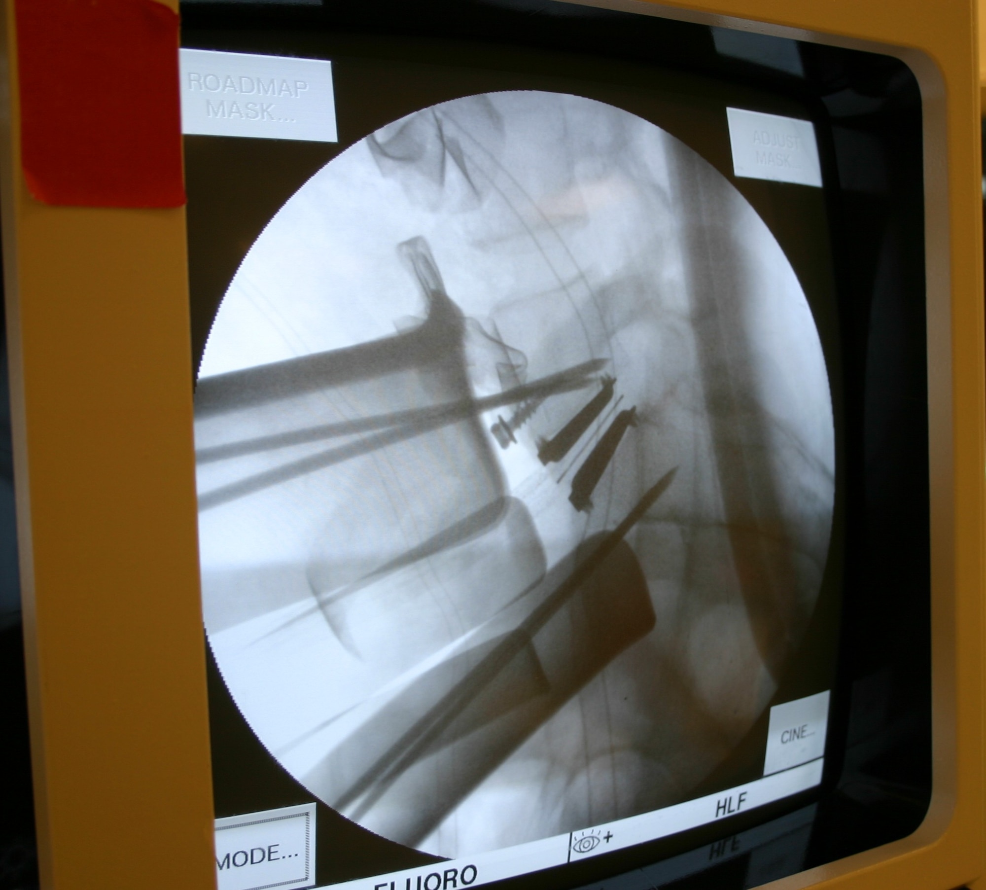 LACKLAND AIR FORCE BASE, Texas -- An X-ray shows the newly placed artificial disc so doctors can ensure proper alignment and movement. With the new disc, a patient is able to regain movement at that site and is able to go back to work within two weeks. (U.S. Air Force photo by 1st Lt. Benjamin Silva)