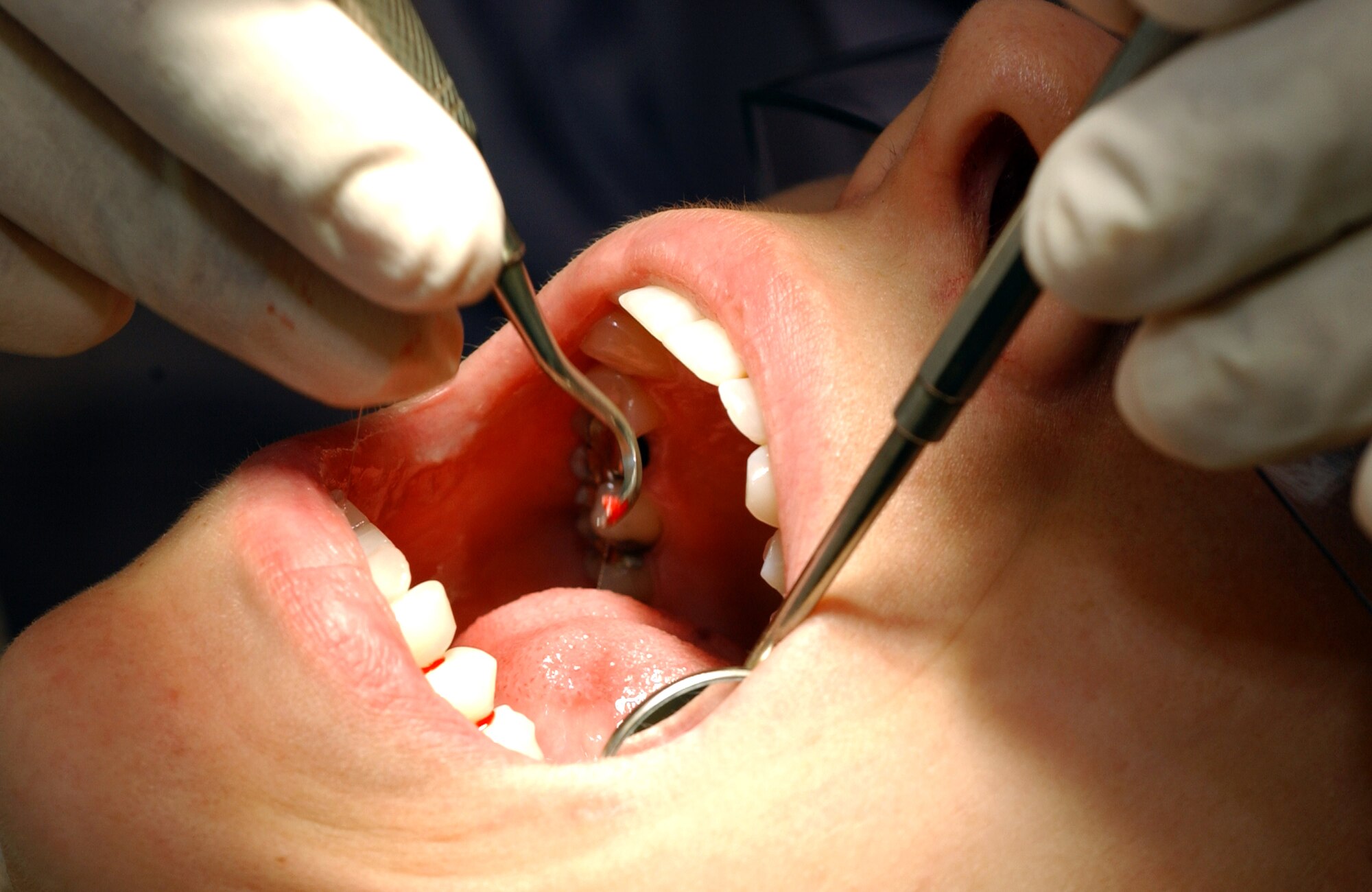 Senior Airman Lauryn Hashem receives a periodic oral exam at Royal Air Force Lakenheath, England, on July 31. The exam includes a cleaning, scaling, polishing, flossing, fluoride treatment and instruction on proper oral hygiene. Airman Hashem is an aircrew life support journeyman for the 492nd Fighter Wing. (U.S. Air Force photo/Senior Airman Kristi Emler) 
