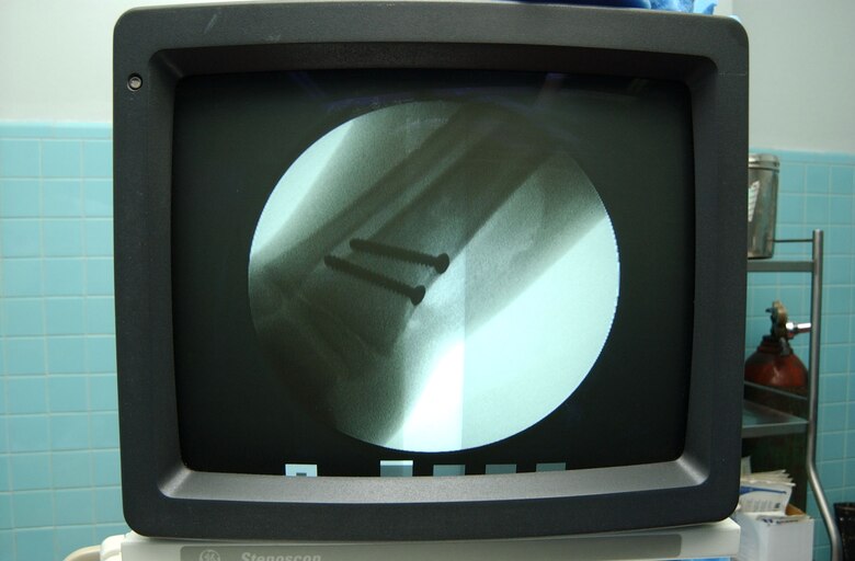 X-rays taken of a 6-year-old boy who was hit by a taxi causing an open fracture to his leg show the screws placed during surgery Aug. 15 at the Hospital Esquela in Tegucigalpa, Honduras. The procedure was accomplished as part of a pediatric orthopedic medical readiness training exercise. A medical team of eight people from Wilford Hall Medical Center at San Antonio and Joint Task Force-Bravo at Soto Cano Air Base, Honduras, treated more than 200 people and operated on more than 60 individuals during its two-week training exercise Aug. 5 to 19. (U.S. Air Force photo/Senior Airman Mike Meares)