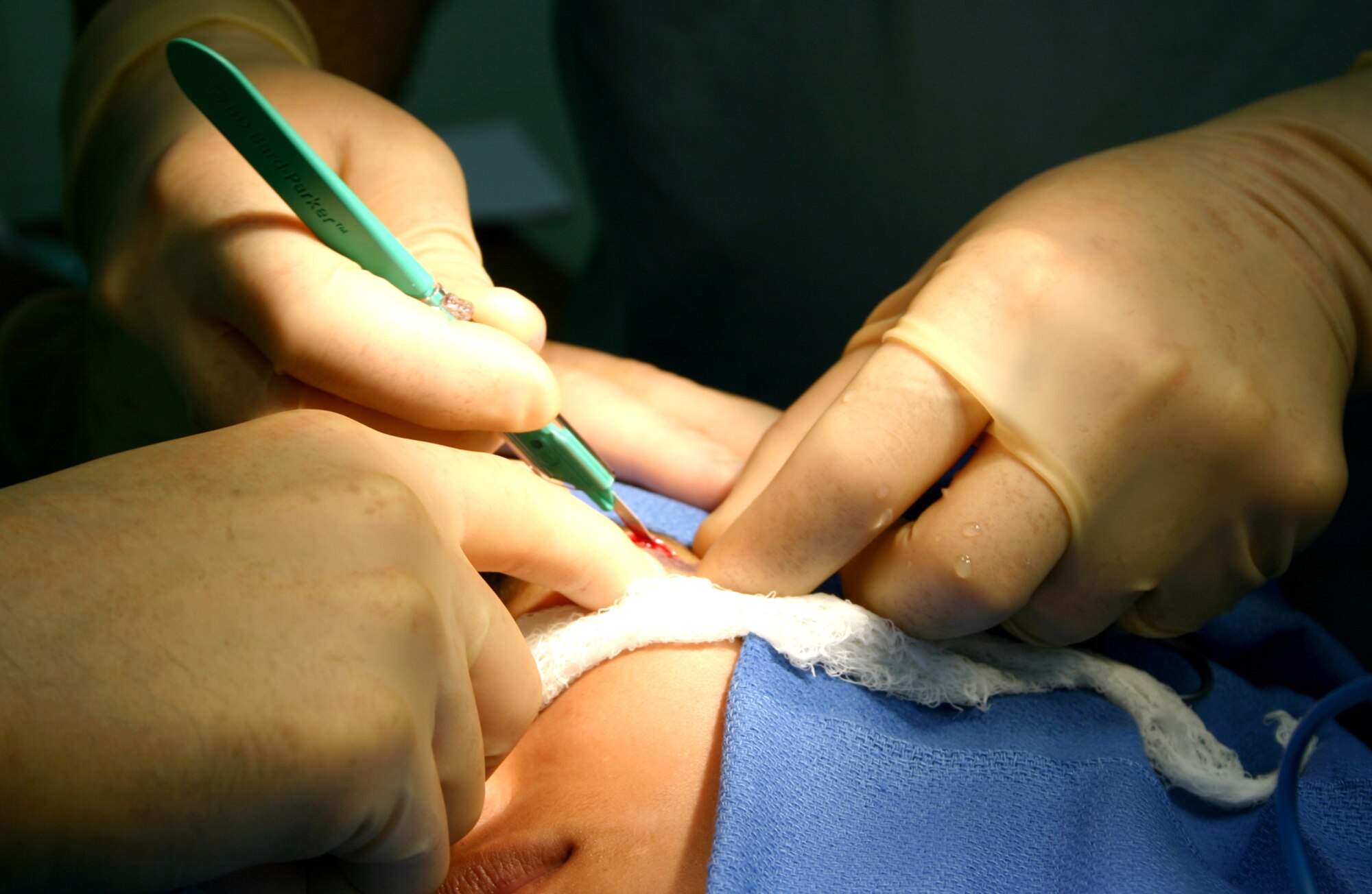 Maj. (Dr.) Matthew Talarczyk performs a scar revision procedure on a 15-year-old girl in Esmereldas, Ecuador, as part of a Medical Readiness Training Exercise. Major Talarczyk is the team leader for the six-person medical crew from Wilford Hall Medical Center at Lackland Air Force Base, Texas, and from Keesler AFB, Miss. (U.S. Air Force photo/2nd Lt. David Herndon) 

