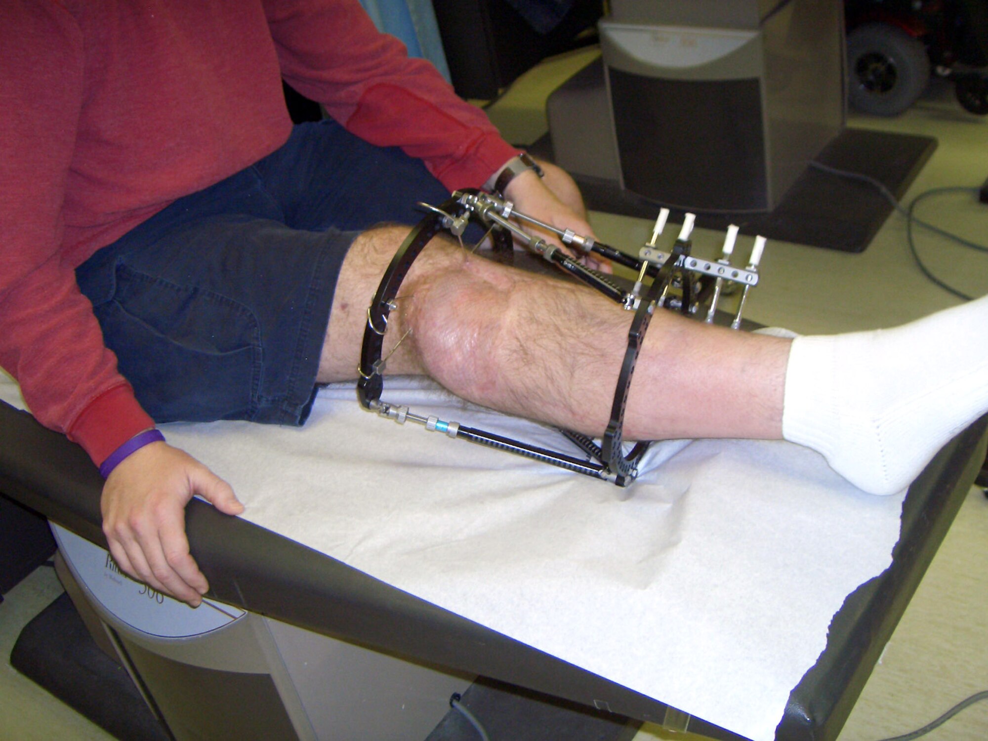 A special exterior leg fixture, called a Taylor Spatial Frame, had to be worn by Maj. Matthew Conlan following surgery for a blast injury received while he was deployed to Bagram Air Base, Afghanistan. The frame works with a computer program to help correct or avoid any deformities through the fracture. Major Conlan had to wear the frame for more than six months. (U.S. Air Force photo/Becky Conlan) 