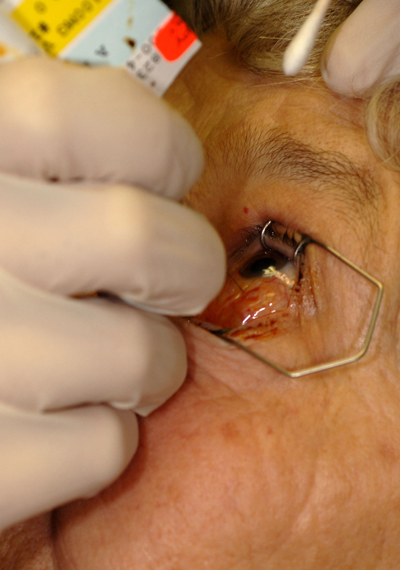 Ms. Betty Disler receives an injection in her left eye at the Wilford Hall Medical Center Ophthalmology Clinic Dec 11. The medication prevents macular degeneration, a disorder that affects central vision. (U.S. Air Force photo by Senior Airman Erin M. Peterson)