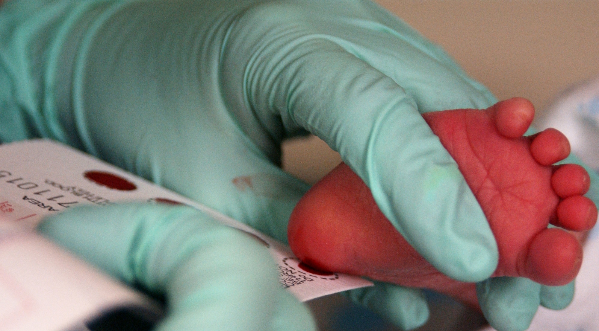 The blood of a two week-old infant is collected for a Phenylketonuria (PKU) screening on December 12, 2007 at Eielson AFB, AK.  PKU is a recessive genetic disorder that can cause problems with brain development, which could lead to mental retardation and seizures. All infants that are born here at Eielson are screened for PKU at their two week well baby check up appointment.

(U.S Air Force photo by Staff Sgt Eric T. Sheler)

