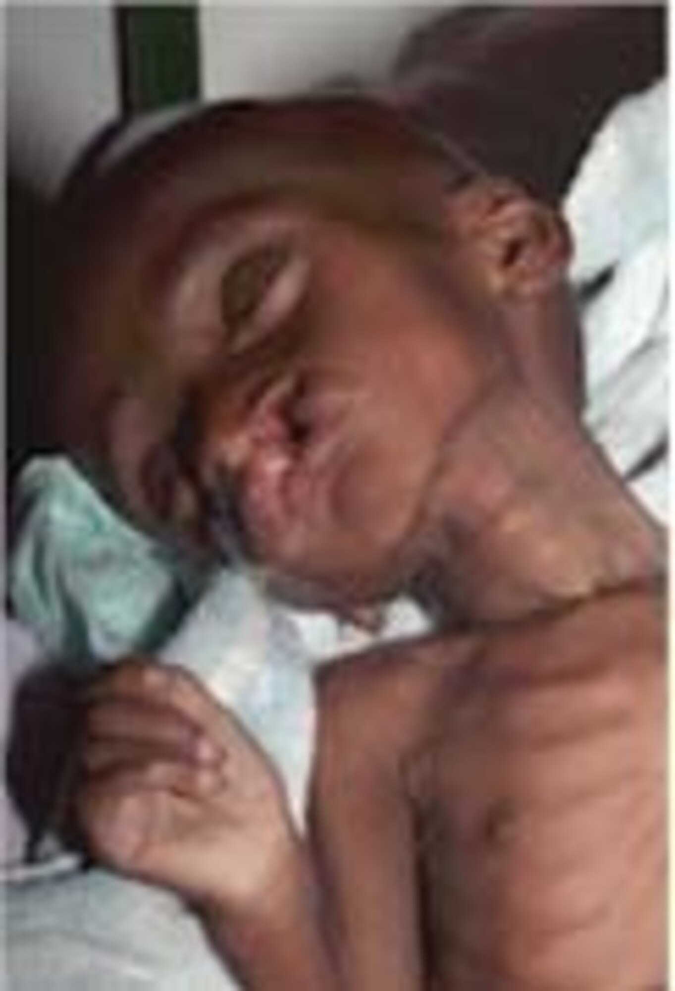 PORT OF TEMA, GHANA -- Mamadou, an eight-month-old patient, was on the brink of death and too skinny to be operated on. 