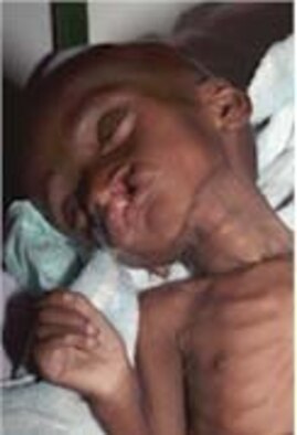 PORT OF TEMA, GHANA -- Mamadou, an eight-month-old patient, was on the brink of death and too skinny to be operated on. 