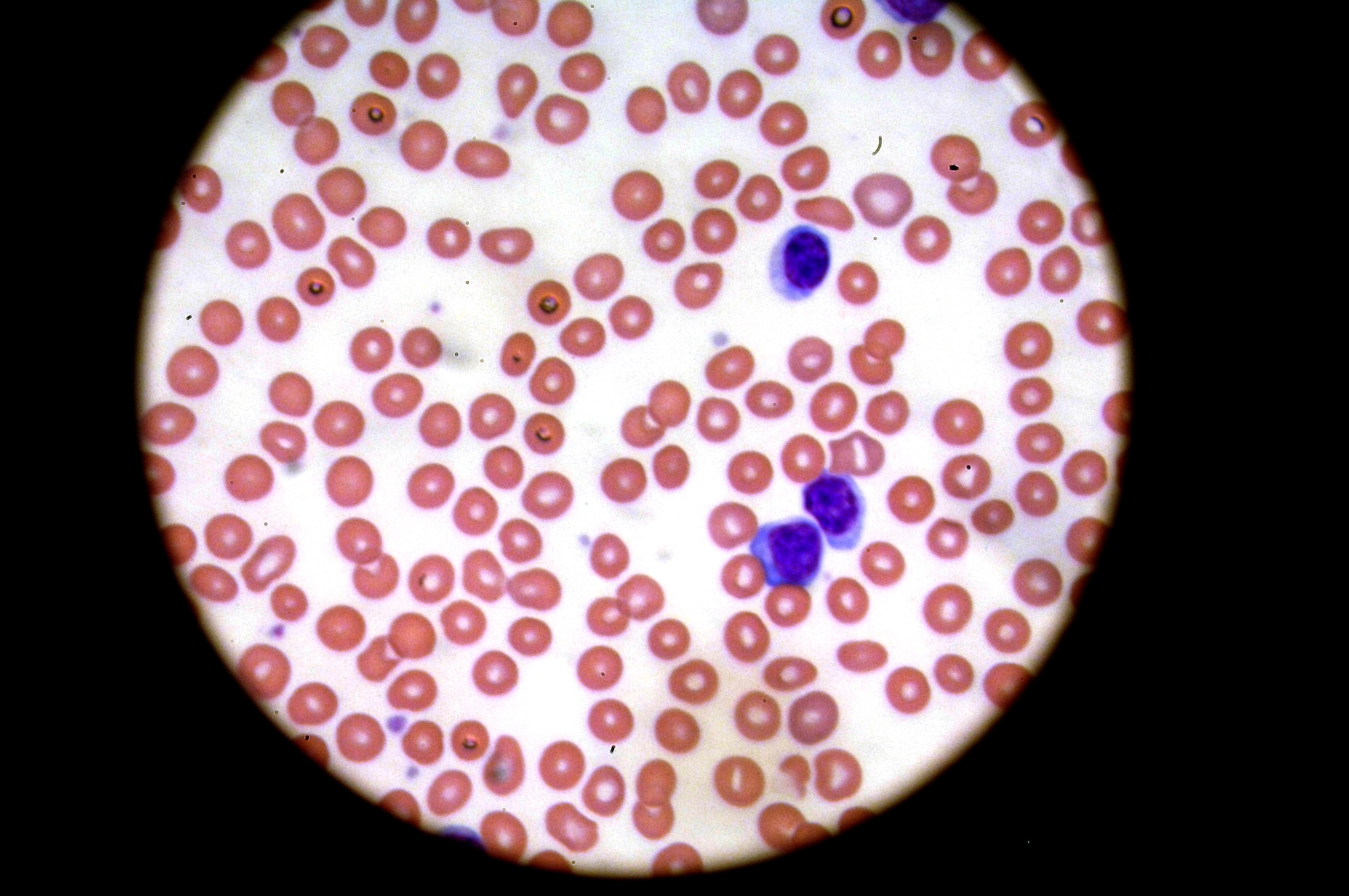 AVIANO AIR BASE, Italy -- The abnormal blood cells of a cancer patient as seen though a microscope.  On a daily basis, medical laboratory technicians use various types of equipment to analyze human tissue samples.  (U.S. Air Force photo/Airman 1st Class Tabitha M. Mans)