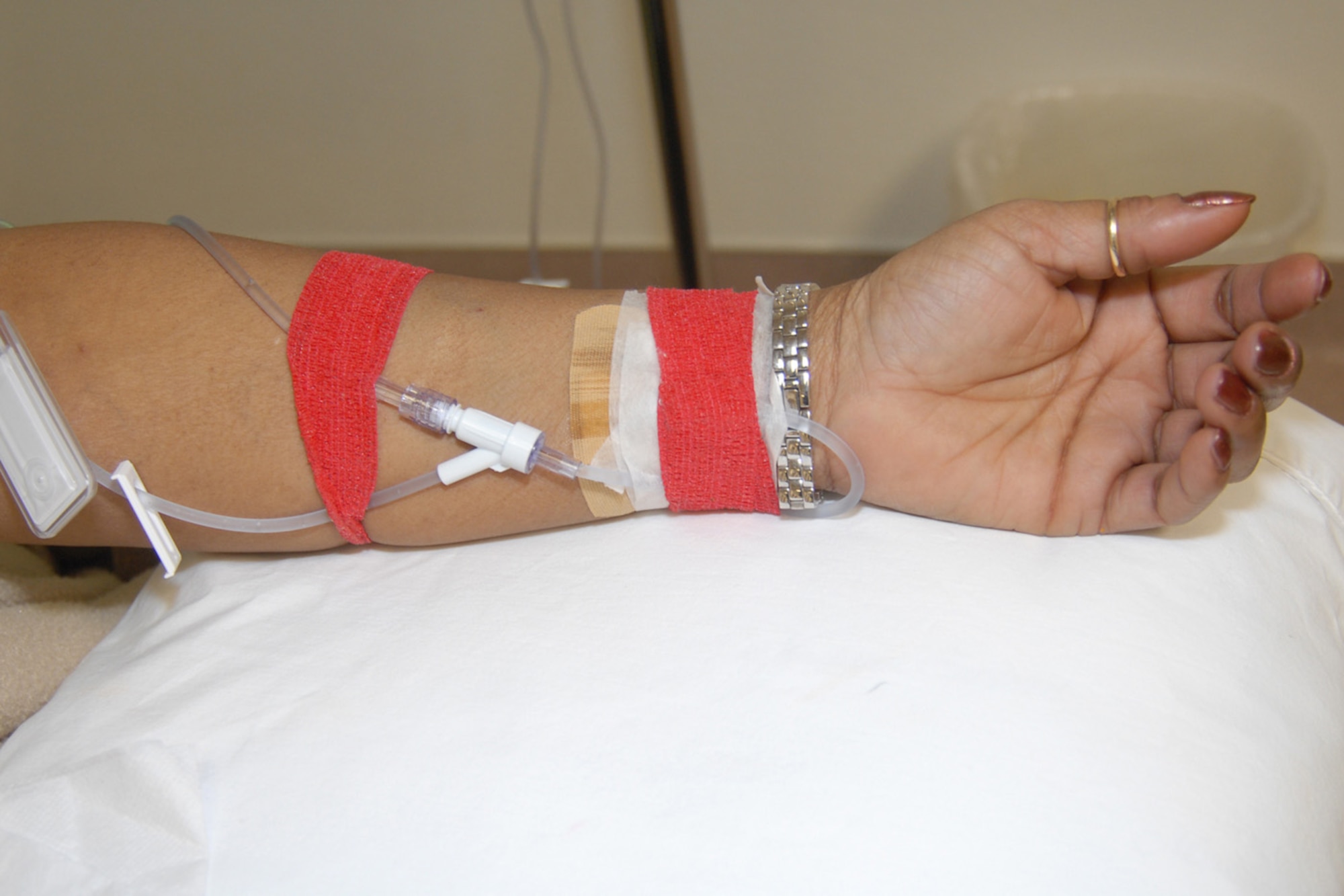 An IV rests inserted into Mrs. Gavins’ arm during a chemotherapy treatment at a hospital. Mrs. Gavins undergoes therapy once a month to help battle her lung cancer.