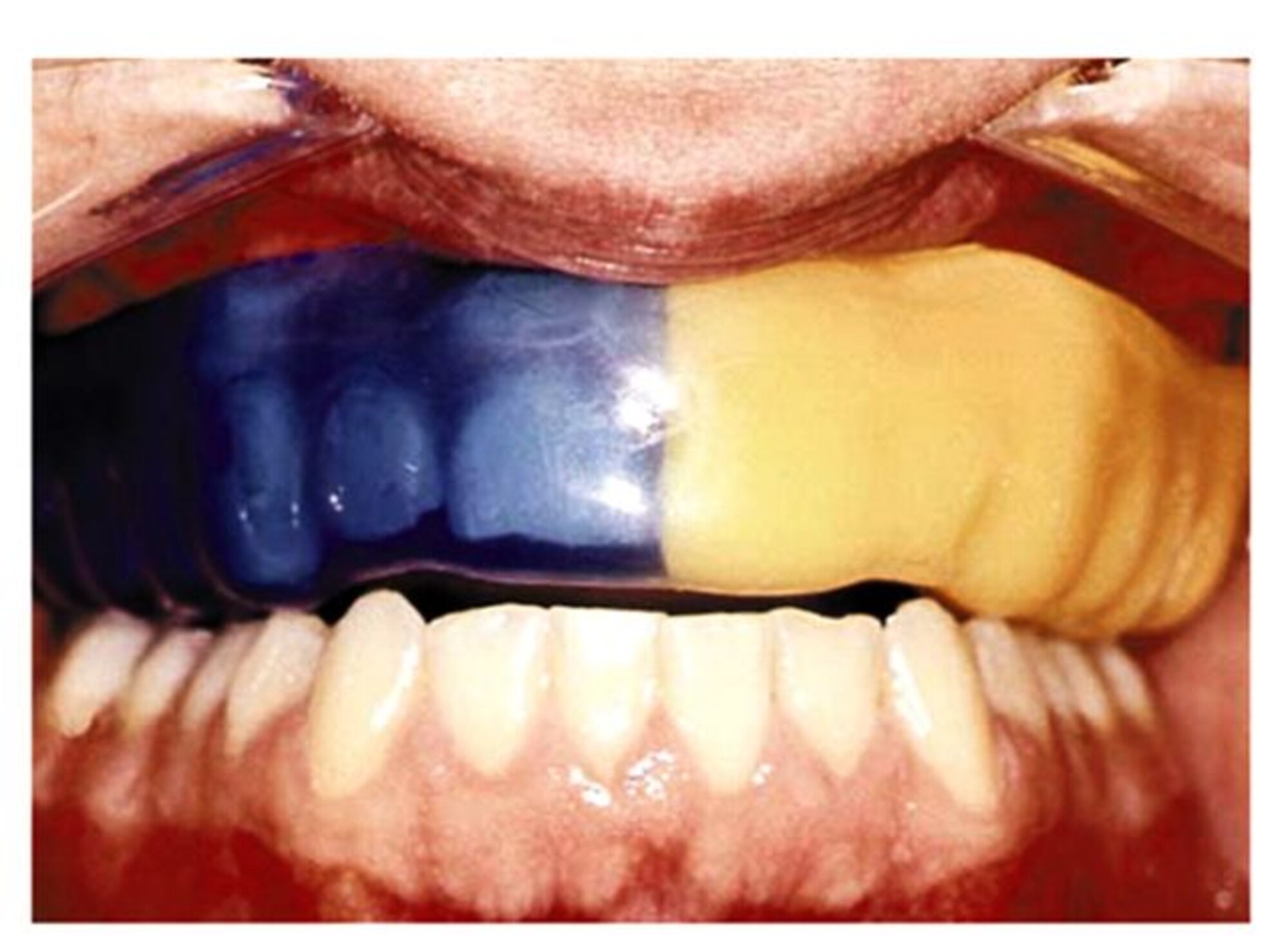 Mouthguards protect teeth (Courtesy graphic)