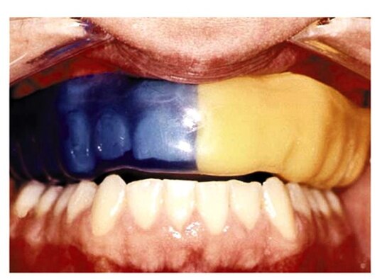 Mouthguards protect teeth (Courtesy graphic)