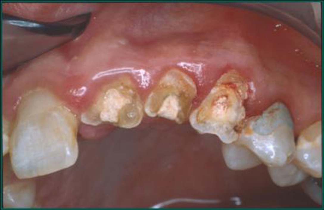 A sports-related dental injury can result in long-term dental problems and expenses.  Wearing an athletic mouthguard offers significant protection. (U.S. Air Force photo)