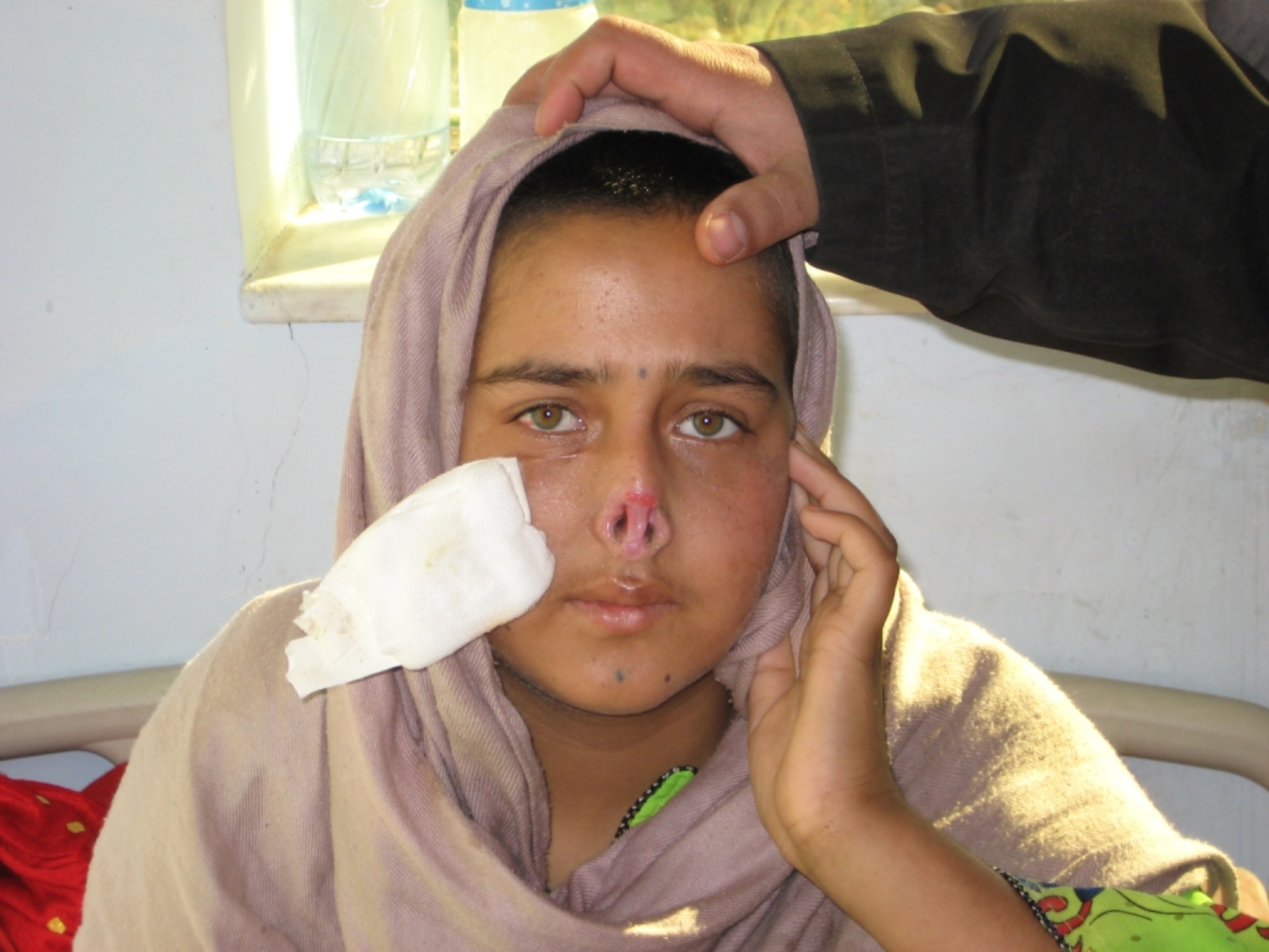 QALAT, Afghanistan – Nazia Hookum Darr, 16, was brutally attacked here by her 40-year-old husband of three months on Christmas day.  The man—who is still on the run from police—broke 16 of his wife’s teeth, shaved her head, cut off her nose and ears and poured scalding water on her hands and feet.  The young woman is set to receive plastic surgery in Kabul following close coordination between the Afghan government and Provincial Reconstruction Team Qalat, a joint U.S. Air Force and Army unit stationed here.  (Air Force photo by Lt. Col. Michael Gauron)