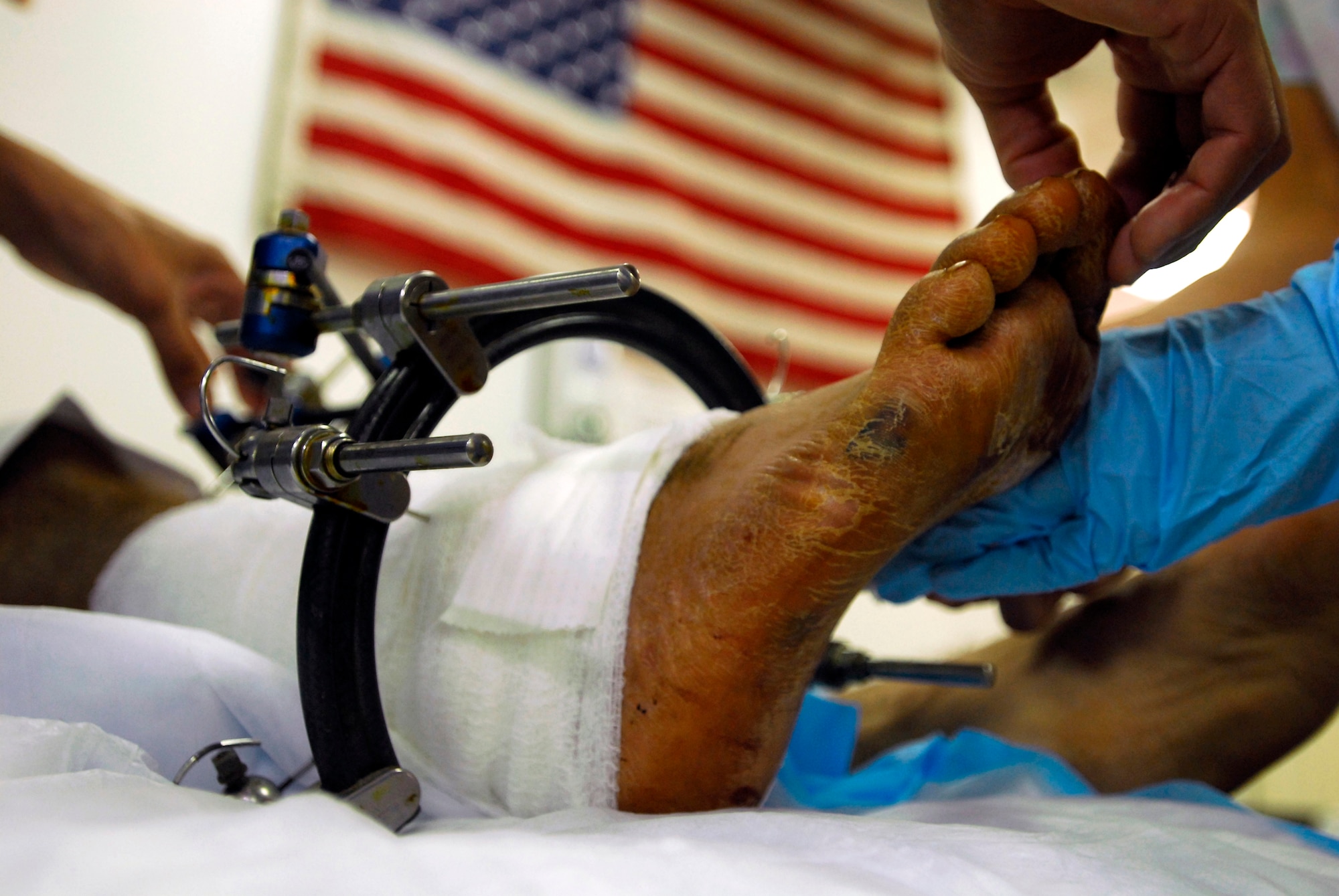 JOINT BASE BALAD, Iraq -- An external fixator attached to Moqdad's leg allows the shattered bones to heal. Moqdad is an Iraqi local whose leg was shattered two months ago. The Air Force Theater Hospital provides care to Iraqi patients twice a week primarily in surgery and occupational and physical therapy. (U.S. Air Force photo/Airman 1st Class Jason Epley)