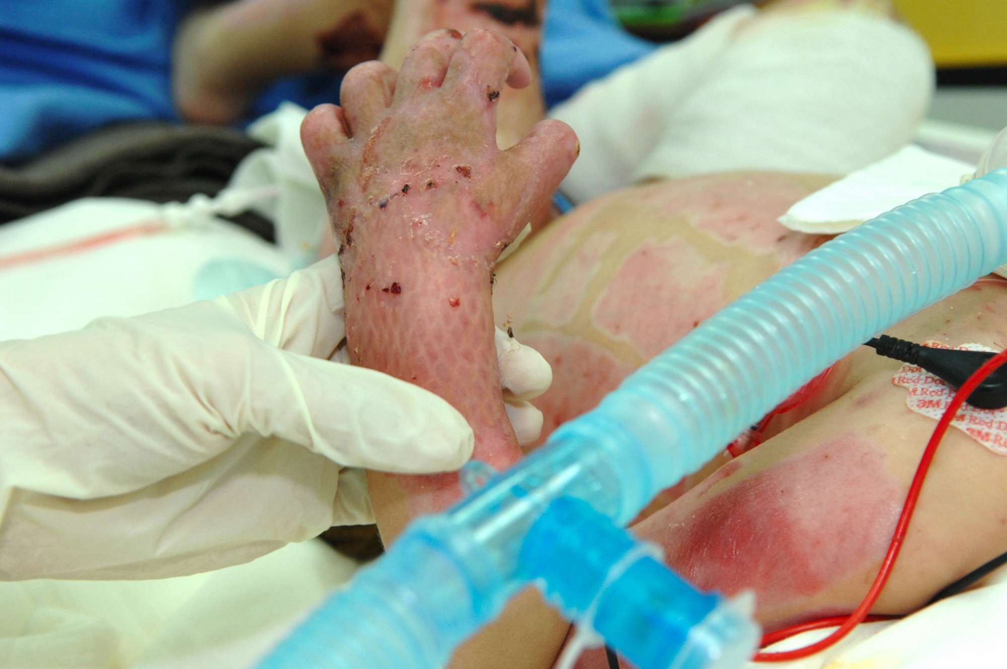 BALAD AIR BASE, Iraq -- The small arm of a 3-year-old Iraqi burn victim is held by his mother's hand March 10 at the Air Force Theater Hospital. The child has been treated at the hospital here since Jan. 25. Due to the efforts of hospital staff members, the boy will be transported to the U.S. to receive additional treatment. (U.S. Air Force Photo/Senior Airman Julianne Showalter) 