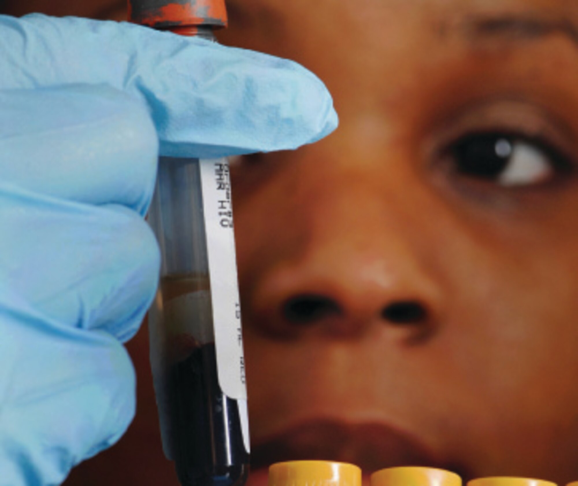 Senior Airman Adrienne Stonum, a medical technician from the 452nd Aerospace Medicine Squadron, March Air Reserve Base, Calif., visually observes a specimen to ensure its quantity is sufficient to perform laboratory tests. Microscopic examinations are used to identify possible bacterial infections and cancerous cells. Laboratory technicians test and analyze specimens using scientific laboratory techniques to aid in the diagnosis, treatment and prevention of diseases. (U.S. Air Force photo by Val Gempis)

Senior Airman Adrienne Stonum 
