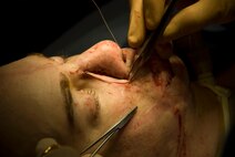 A skin graft taken from Aaron Mankin's chest is placed over the exposed tissue left on the left side of his nose after doctors performed a surgery to thin out his nose Nov. 18 at UCLA Medical Center. Mankin has had more than 50 surgeries since he was wounded May 11, 2005. Twelve of them have been at UCLA Medical Center through Operation Mend, a partnership between the U.S. military and UCLA Medical Center, through which UCLA provides world-class plastic reconstructive surgeries to disfigured service members. (Official U.S. Marine Corps photo by Staff Sgt. Ethan E. Rocke)