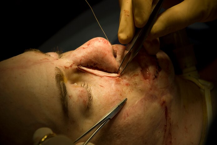 A skin graft taken from Aaron Mankin's chest is placed over the exposed tissue left on the left side of his nose after doctors performed a surgery to thin out his nose Nov. 18 at UCLA Medical Center. Mankin has had more than 50 surgeries since he was wounded May 11, 2005. Twelve of them have been at UCLA Medical Center through Operation Mend, a partnership between the U.S. military and UCLA Medical Center, through which UCLA provides world-class plastic reconstructive surgeries to disfigured service members. (Official U.S. Marine Corps photo by Staff Sgt. Ethan E. Rocke)
