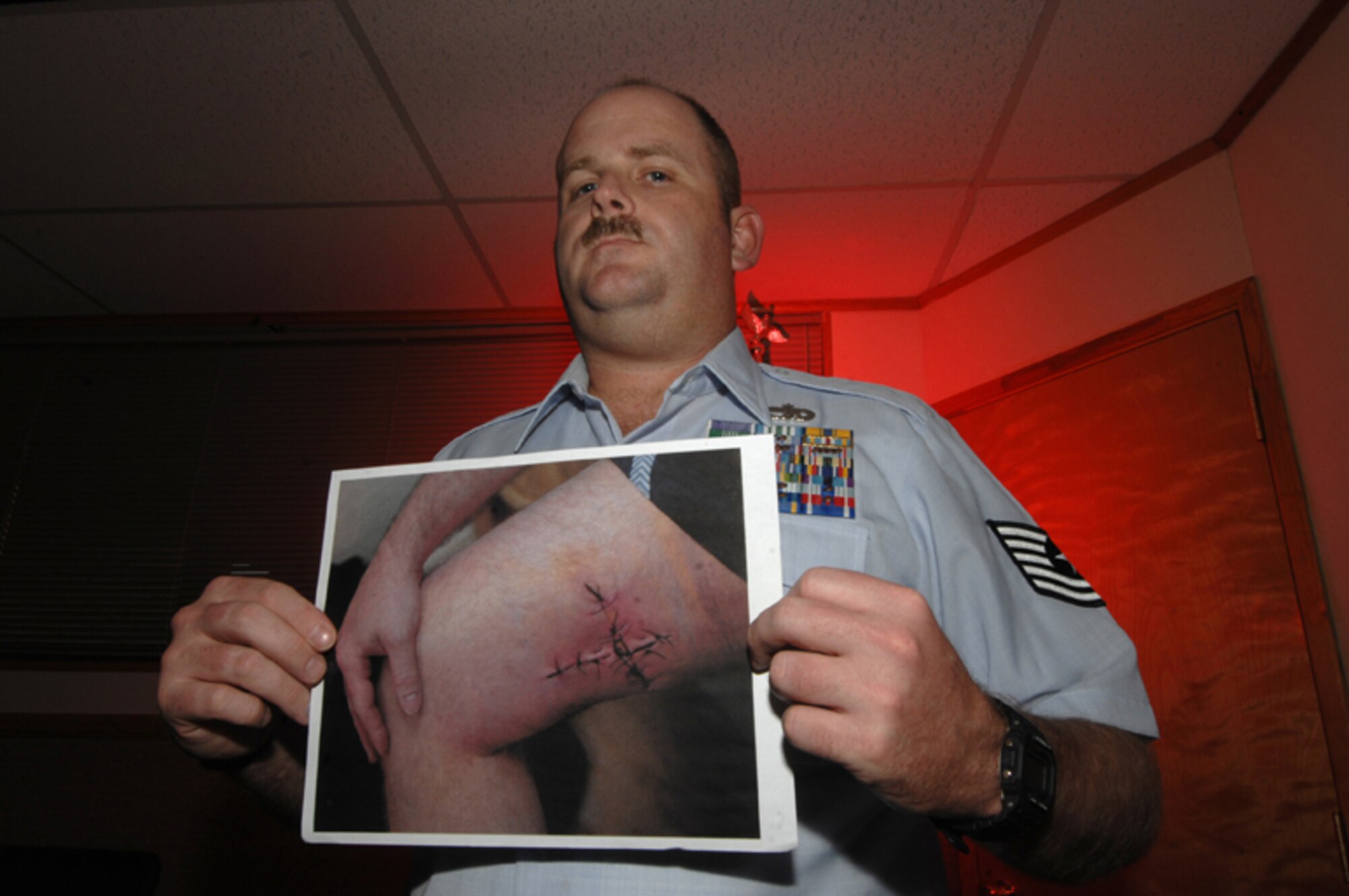 Tech. Sgt. Jerome Baker, 56th Logistics Readiness training NCO, shows off a photo taken after his first surgery in Baghdad, Iraq.   (U.S. Air Force photo by Tech. Sgt. Jeffrey A. Wolfe)