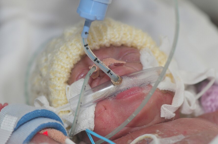 Alexis Frazier and her brother Eric were born four months premature Sept. 6. Aged 6 weeks and 2 days at the time of this photo, both babies are severely underweight and are constantly on ventilation. Born so early, they are both suffering from heart and lung problems and need surgery to help them on their long road to recovery. (U.S. Air Force photo by Karen Abeyasekere)
