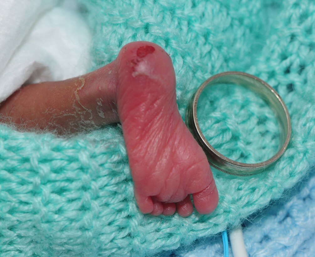 This tiny foot belongs to Eric LeVon Frazier II, twin brother of Alexis Rain Frazier, born prematurely Sept. 6 at just 23 weeks and 3 days gestation period. The wedding band, belonging to Eric's father, Tech. Sgt. Barry Frazier, 100th Air Refueling Wing Legal Office, shows how small the babies are. Sergeant Frazier, and his wife Mandy, visit their twins every day at the Norfolk and Norwich University Hospital. The twins due date was Jan. 1, 2009 -- they were born four months early. (U.S. Air Force photo by Karen Abeyasekere)