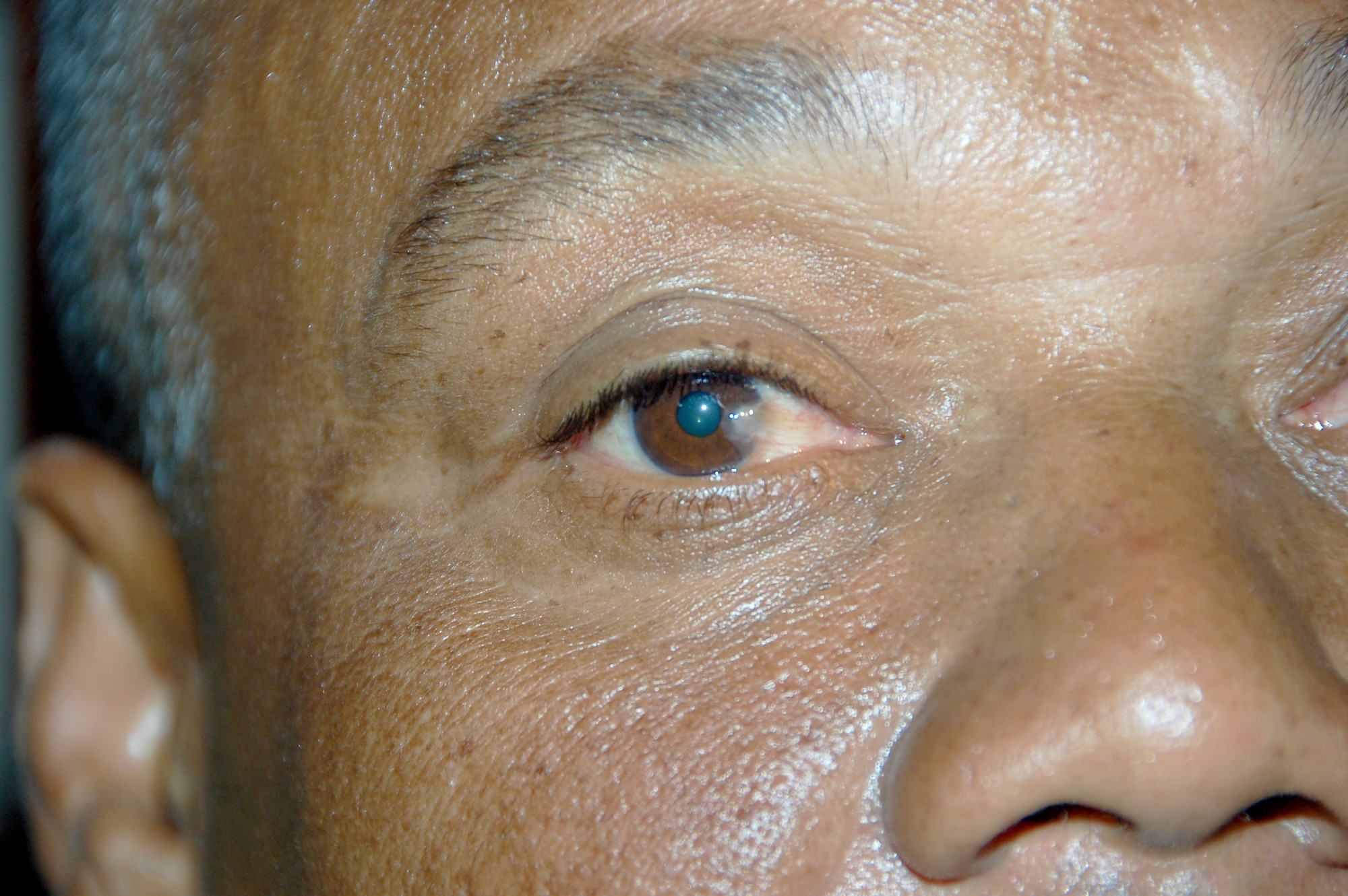 A patient with pterygiums, a condition where the white part of the eye begins to grow over the cornea and eventually over the pupil, and cataracts, which cause the pupils to appear cloudy receives optometric care from U.S. Air Force medics at a primary school in Hostos, Dom. Rep., April 22 during the largest Maxwell Air Force Base-planned U.S. Air Force Medical Readiness Training Exercise (MEDRETE) to date. A group of 45 medics, translators, security and support personnel derived from the U.S. Air Force, Army and Marines provided dental, dermatologic, general medicine, optometric, pediatric, pharmacy and public health services. The medics treated approximately 4,000 patients during the first four days of the U.S. SOUTHCOM sponsored Beyond the Horizon 2009 – Caribbean. A MEDRETE is a U. S. Southern command-sponsored exercise designed to provide humanitarian assistance and free medical care to the people of the host nation, while providing an unparalleled training opportunity for U.S. and host nation forces. SOUTHCOM sponsors approximately 70 MEDRETEs per year. (U.S. Air Force Photo by Capt. Ben Sakrisson)