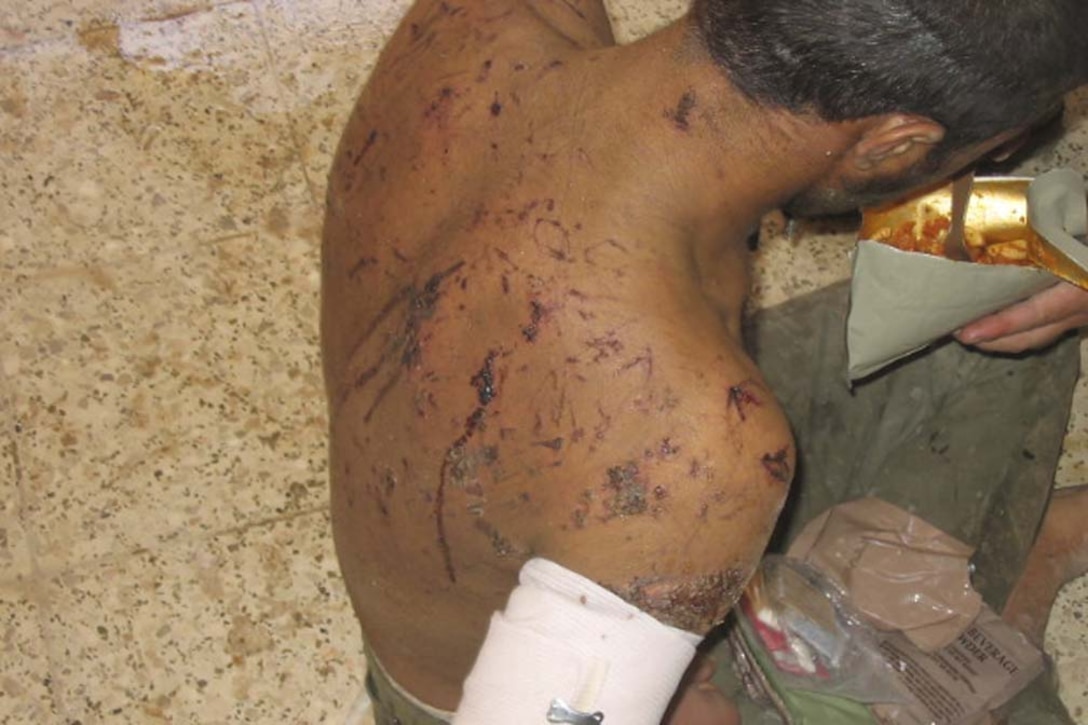 KARABILAH, Iraq (June 17, 2005) - An Iraqi man, who was held captive and beaten, had welts and lacerations across his back and arms from being tortured with electricity. This man and three others were rescued by Iraqi Security Forces and Marines from 3rd Battalion, 2nd Marine Regiment who discovered an insurgent torture chamber in the city of Karabilah, Iraq during Operation Romhe. The Marines had entered a building which they believed to be a car bomb factory finding these men. The man was hung by his feet, head dipped in water and then tortured with electric shock. The four Iraqis received immediate first aid and were transported to a medical facility for further treatment and recovery.  Operation Romhe's mission is to destroy strong points held by insurgents in the city of Karabilah. The Marines of 2nd Marine Division conduct counter-insurgency operations with Iraqi Security Forces to isolate and neutralize Anti-Iraqi Forces, to support the continued development of Iraqi Security Forces, and to support Iraqi reconstruction and democratic elections in order to create a secure environment that enables Iraqi self-reliance and self-governance. (Official USMC Photo by SSgt Jason D. Becksted)