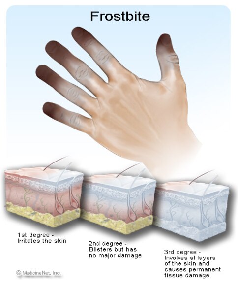 MINOT AIR FORCE BASE, N.D. -- Frostbite is an injury to the body that is caused by freezing. Frostbite causes a loss of feeling and color in affected areas. It most often affects the nose, ears, cheeks, chin, fingers, or toes. Frostbite can permanently damage the body and in severe cases can lead to amputation. The risk of frostbite is increased in people with reduced blood circulation and among people who are not dressed properly for extremely cold temperatures. (courtesy graphic)