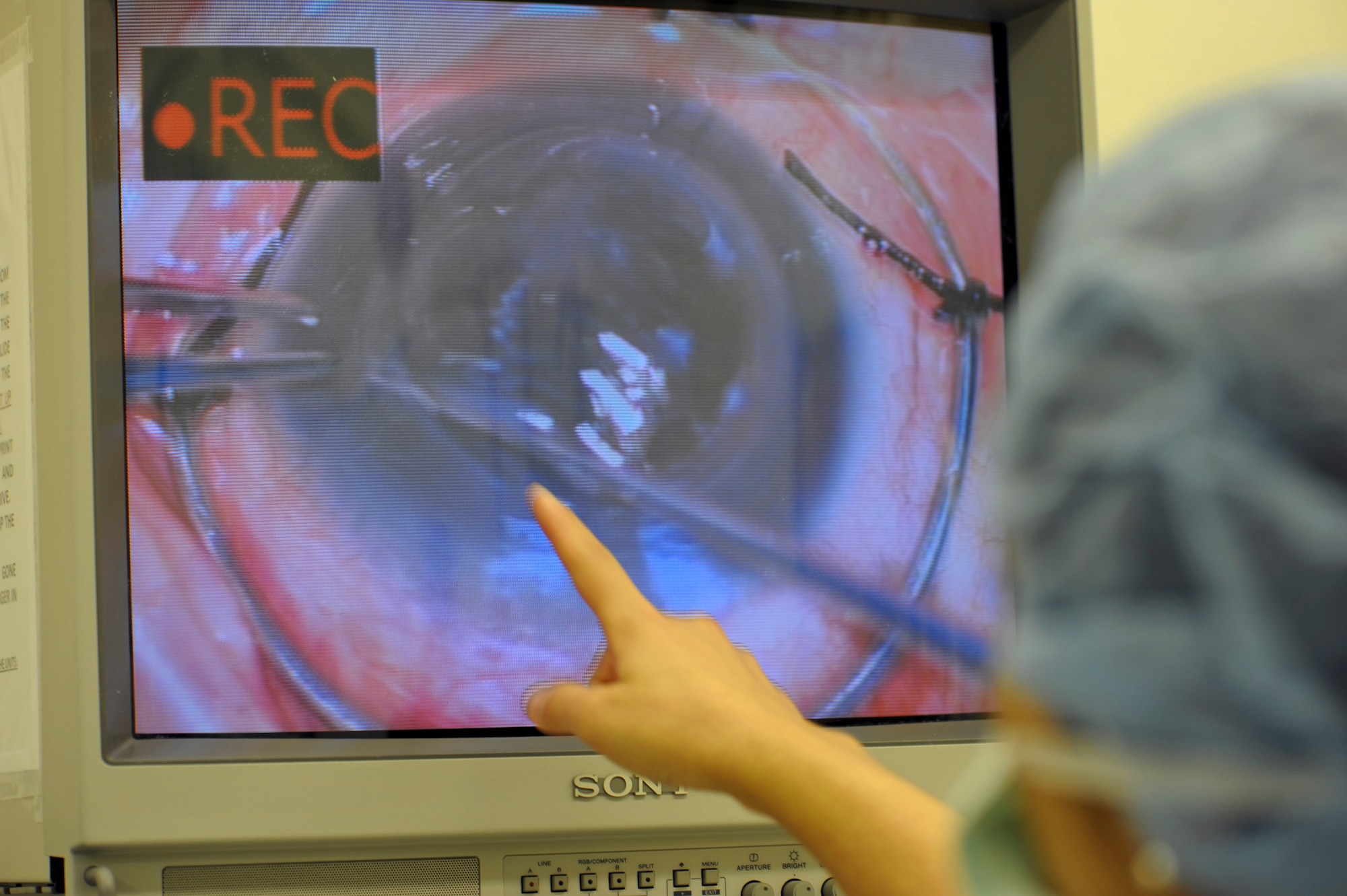 Dr. Adriana Ramirez watches the corneal transplantation on Gloria Bolick Dec. 22, 2009, at Wilford Hall Medical Center at Lackland Air Force Base, Texas. Doctor Ramirez is an ophthalmology resident at University of Texas Health Science Center. (U.S. Air Force photo/Staff Sgt. Desiree N. Palacios) 
