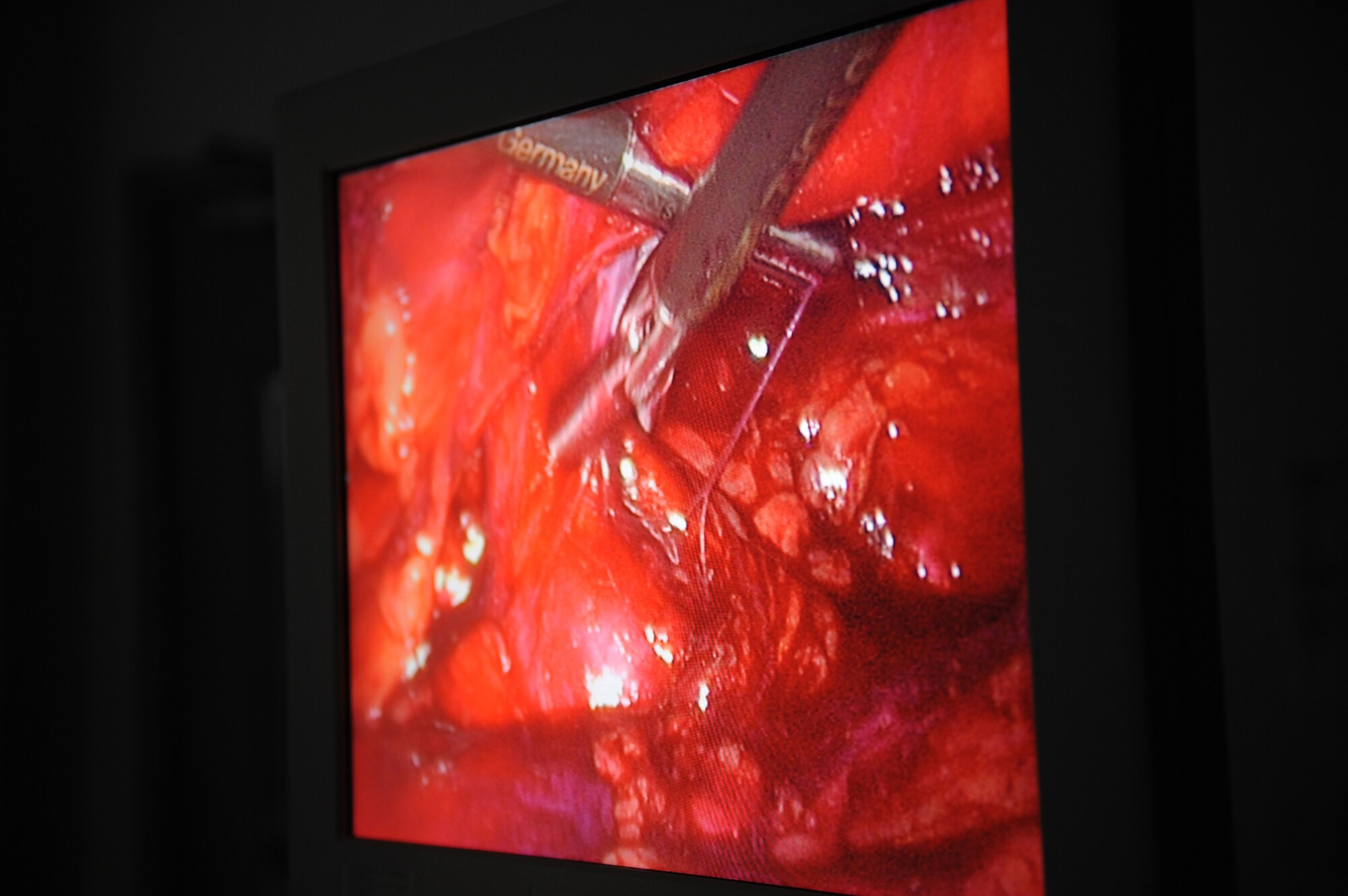 A view of the surgery monitor as Major (Doctor) Brian Holt, 379th Expeditionary Medical Group general surgeon, uses laparoscopic graspers during an inguinal hernia surgery, June 5, 2009, at an undisclosed location in Southwest Asia.  This specific surgery allows the patient to return to duty quicker and with less pain.  The surgeries performed here range from elective to acute emergencies.  The surgical team provides treatment for patients coming in from all over the U.S. Central Command's Area of Responsibility.  Major Holt hails from St. Peters, Mo. and is deployed from Misawa Air Base, Japan in support of Operations Iraqi and Enduring Freedom and Combined Joint Task Force - Horn of Africa.  (U.S. Air Force photo/Senior Airman Andrew Satran/released)