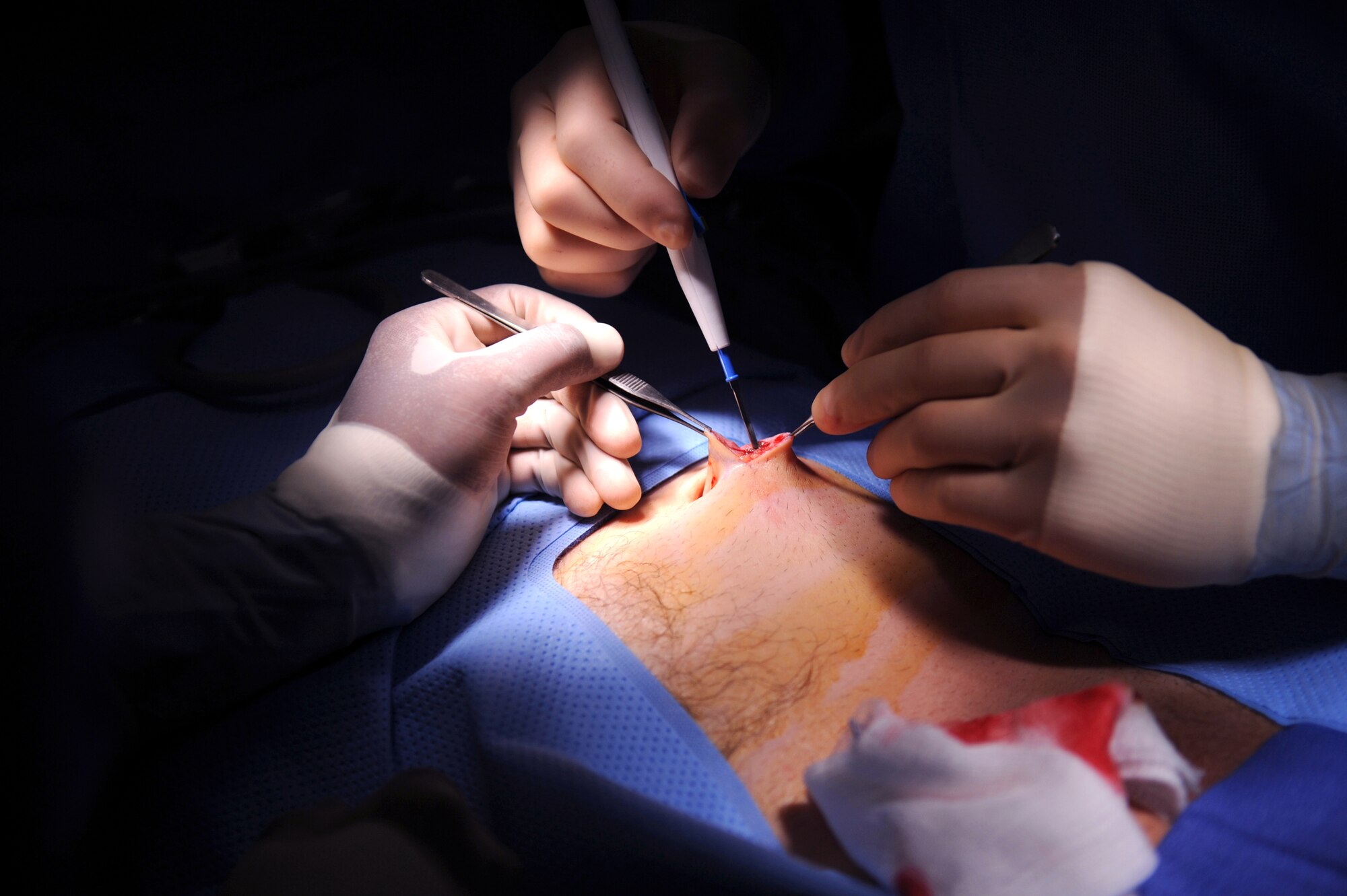Major (Doctor) Brian Holt, 379th Expeditionary Medical Group General Surgeon, obtains surgical access via an infraumbilical incision during an operation for an inguinal hernia June 5, 2009 at an undisclosed location in Southwest Asia.  This specific surgery allows the patient to return to duty quicker and with less pain.  The surgeries performed here range from elective to acute emergencies.  The surgical team provides treatment for patients coming in from all over the U.S. Central Command's Area of Responsibility.  Major Holt hails from St. Peters, Mo. and is deployed from Misawa Air Base, Japan, in support of Operations Iraqi and Enduring Freedom and Combined Joint Task Force - Horn of Africa.  (U.S. Air Force photo/Senior Airman Andrew Satran/released)
