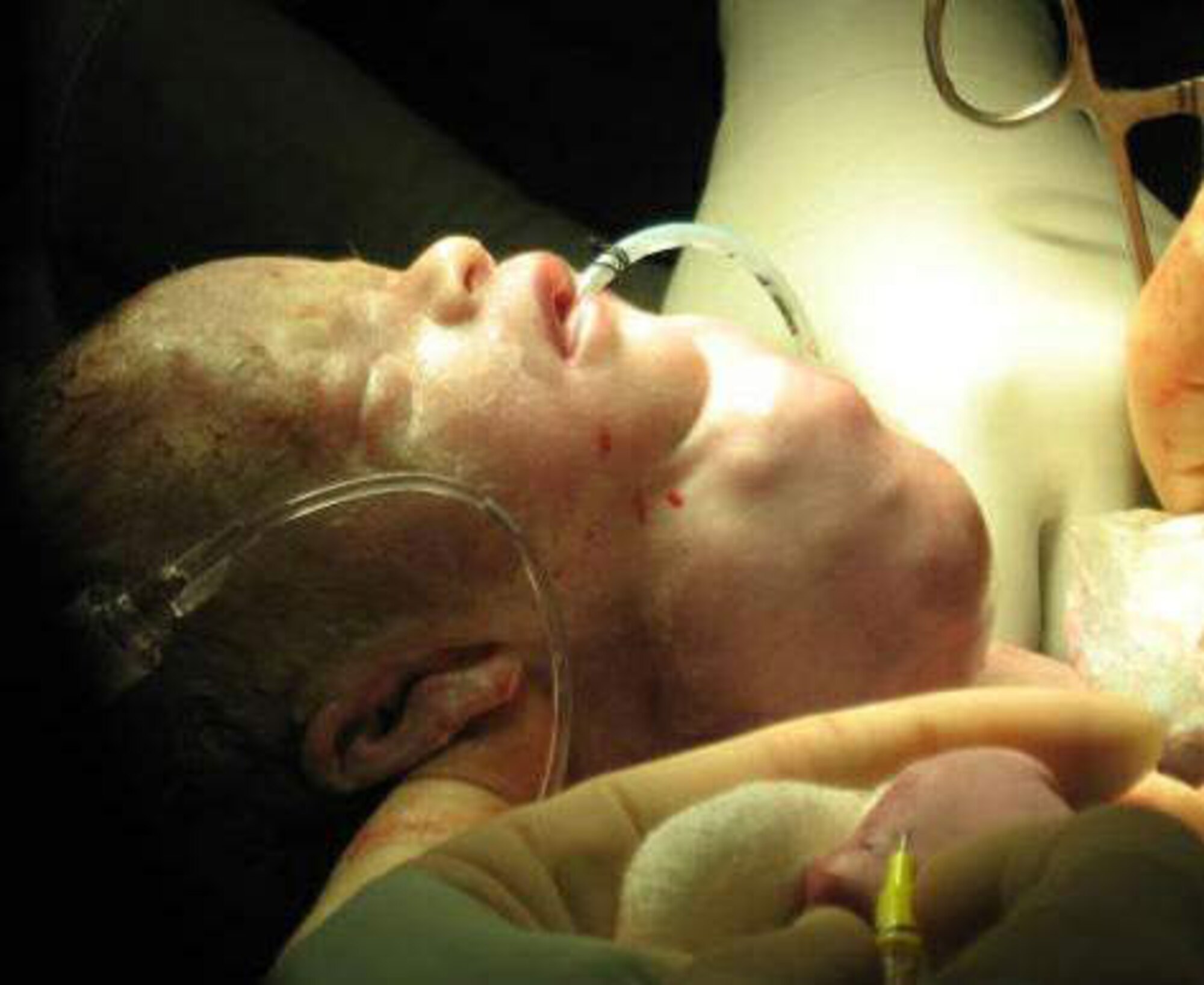 Alexander Gardner is intubated while his body is still in his 
mother's uterus at Wilford Hall Medical Center Feb. 27. The rare procedure, 
call EXIT, for ex-utero intrapartum treatment, was performed by an Air Force 
medical team to open the baby's airway which was blocked by a large tumor on 
his neck. The baby is the son of Army Staff Sgt. Christopher Gardner, 
assigned to 23rd Armored Calvary Regiment at Ft. Hood, Texas, and is 
recovering in the Wilford Hall Neonatal Intensive Care Unit. (U.S. Air 
Force photo) 
