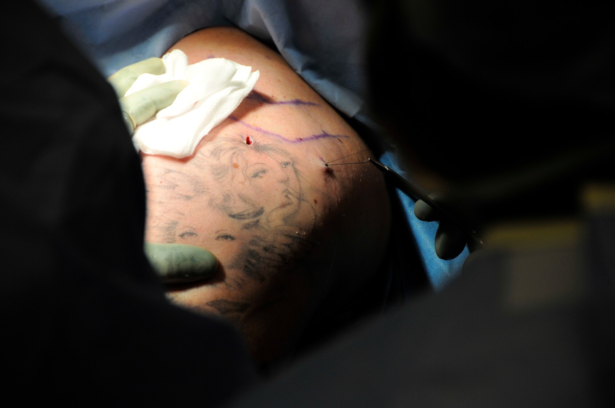 ROYAL AIR FORCE LAKENHEATH, England -- Major Kenneth Bode, 48th Surgical Operations Squadron orthopedic surgeon sutures one of the small incisions after performing arthroscopic shoulder surgery on Tech. Sgt. Christopher Campbell, 48th Fighter Wing Public Affairs non-commissioned officer in charge of internal operations April 29, 2009 at the 48th Medical Group Hospital. Arthroscopy is a minimally invasive surgical procedure, with small incisions for the scope and tools. This reduces recovery time and may increase the rate of surgical success due to less trauma to the connective tissue. (U.S. Air Force photo by Airman 1st Class Perry Aston) (Released)