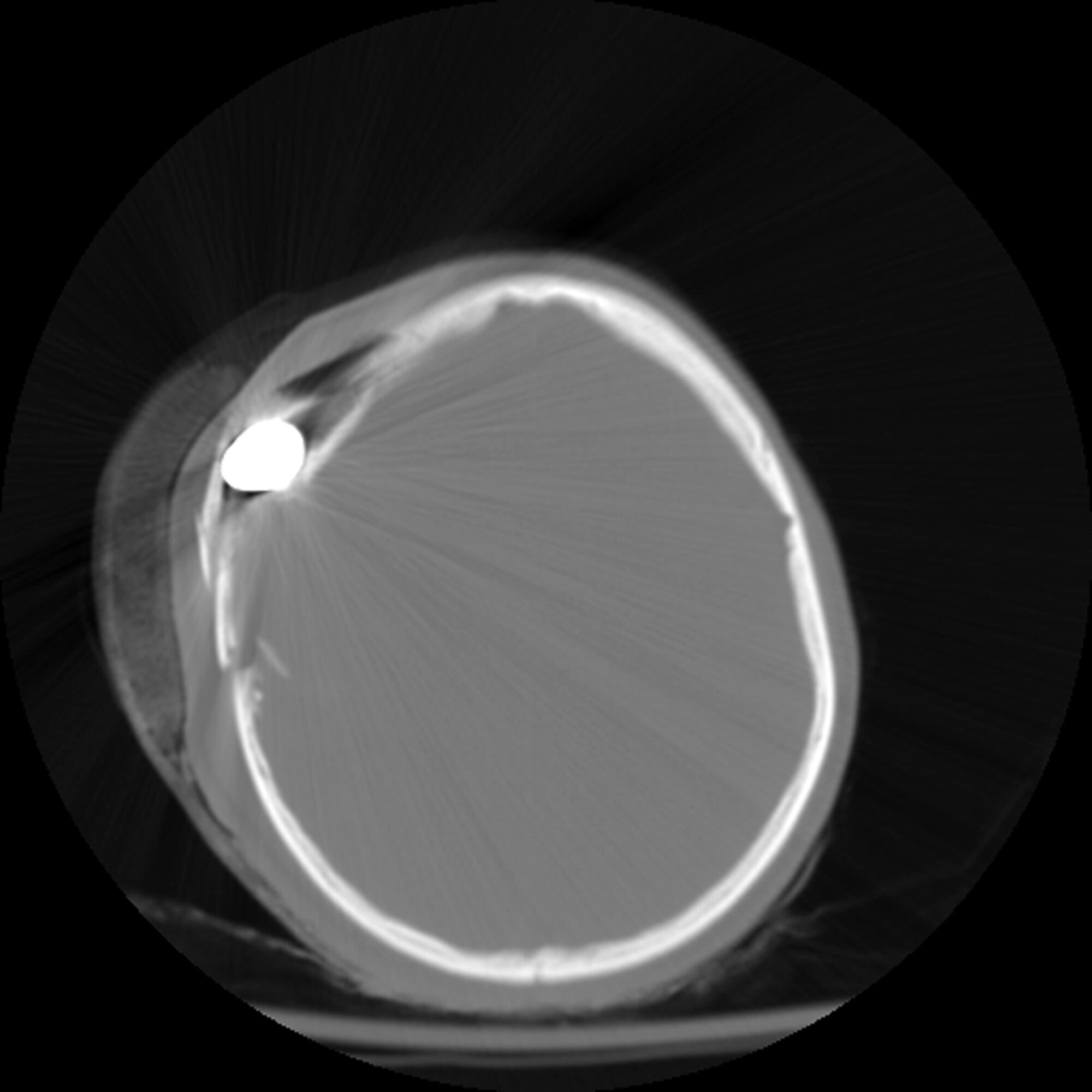 This computerized axial tomography scan image shows the placement of a 14.5 mm high explosive incendiary round that was removed from the scalp of an Afghan National Army soldier March 18, 2010, at the Craig Joint Theater Hospital at Bagram Airfield, Afghanistan. The injury was sustained during an improvised explosvie device attack. (Courtesy photo)