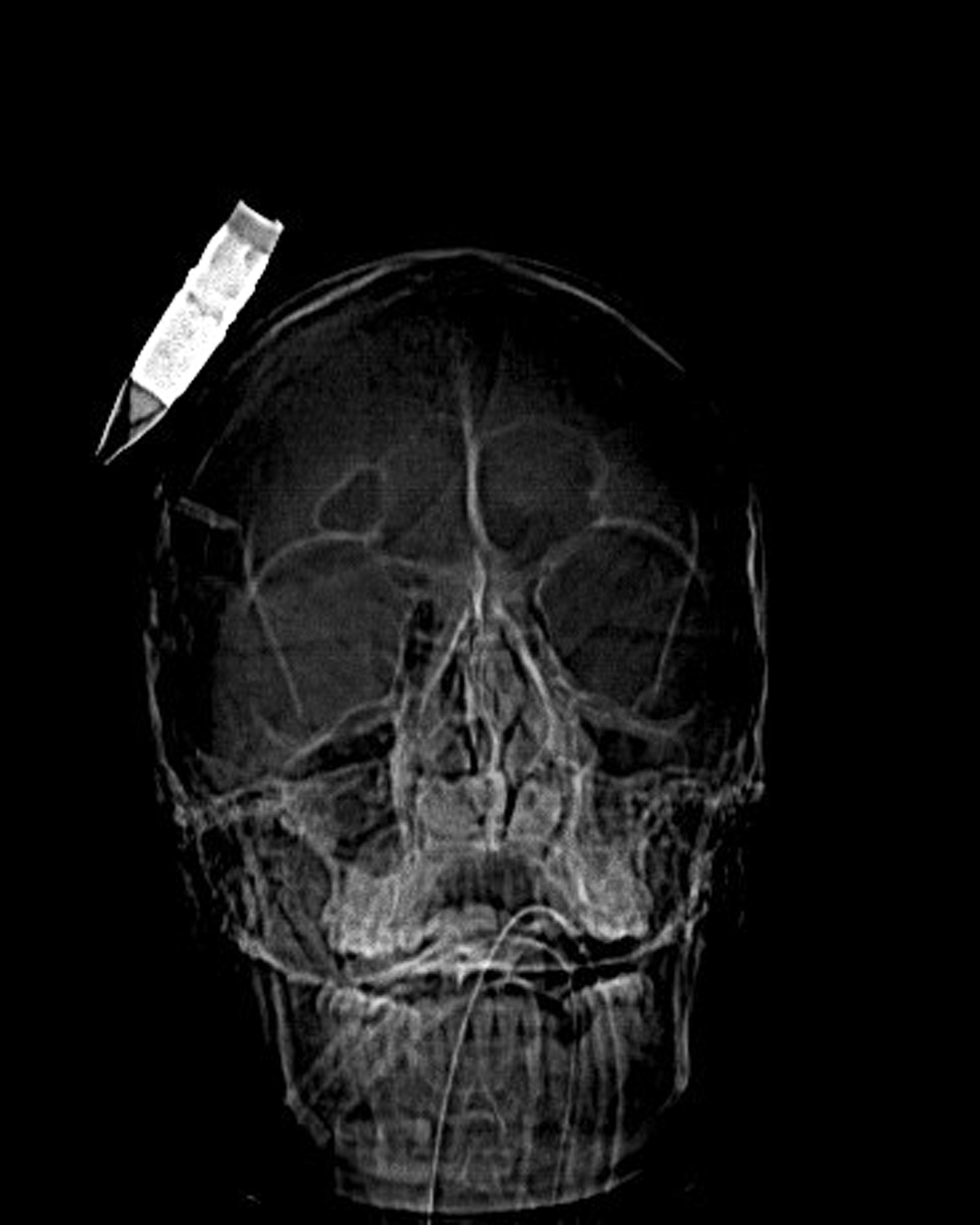 This computerized axial tomography scan image shows the placement of a 14.5 mm high explosive incendiary round that was removed from the scalp of an Afghan National Army soldier March 18, 2010, at the Craig Joint Theater Hospital at Bagram Airfield, Afghanistan. The injury was sustained during an improvised explosive device attack. (Courtesy photo)
