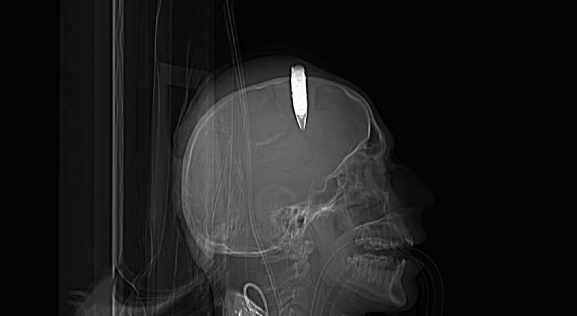 This computerized axial tomography scan image shows the placement of a 14.5 mm high explosive incendiary round that was removed from the scalp of an Afghan National Army soldier March 18, 2010, at the Craig Joint Theater Hospital at Bagram Airfield, Afghanistan. The injury was sustained during an improvised explosive device attack. (Courtesy photo)