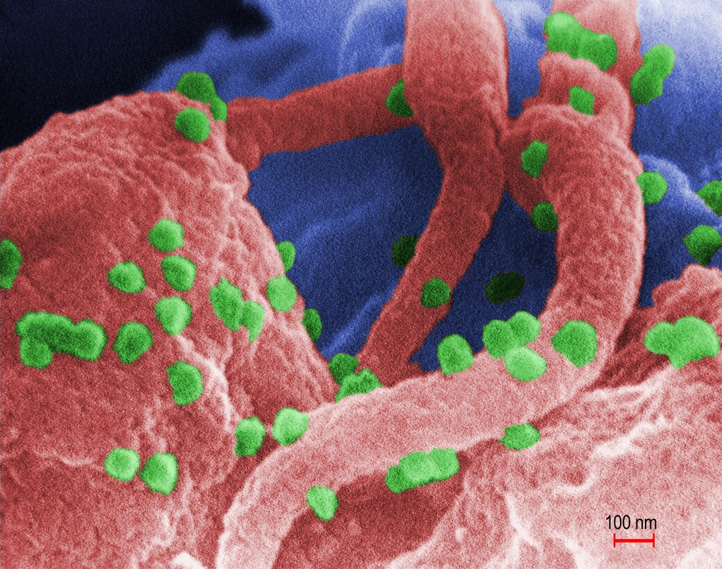 This scanning-electron micrograph shows human immunodeficiency virus (HIV-1) particles in green on the surface of a lymphocyte, a cell that plays a key role in the human immune system. Centers for Disease Control and Prevention photo by C. Goldsmith, P. Feorino, E.L. Palmer, W.R. McManus