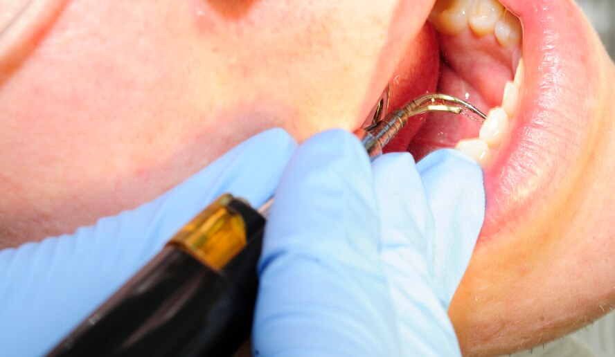 RAF MILDENHALL, England -- A cavitron water pick is used to remove plaque from a patient's teeth during his yearly cleaning Dec. 2, 2010. The water pick is used to break down heavy buildups of plaque on and in between the teeth and wash it away. (U.S. Air Force photo/Senior Airman Ethan Morgan)