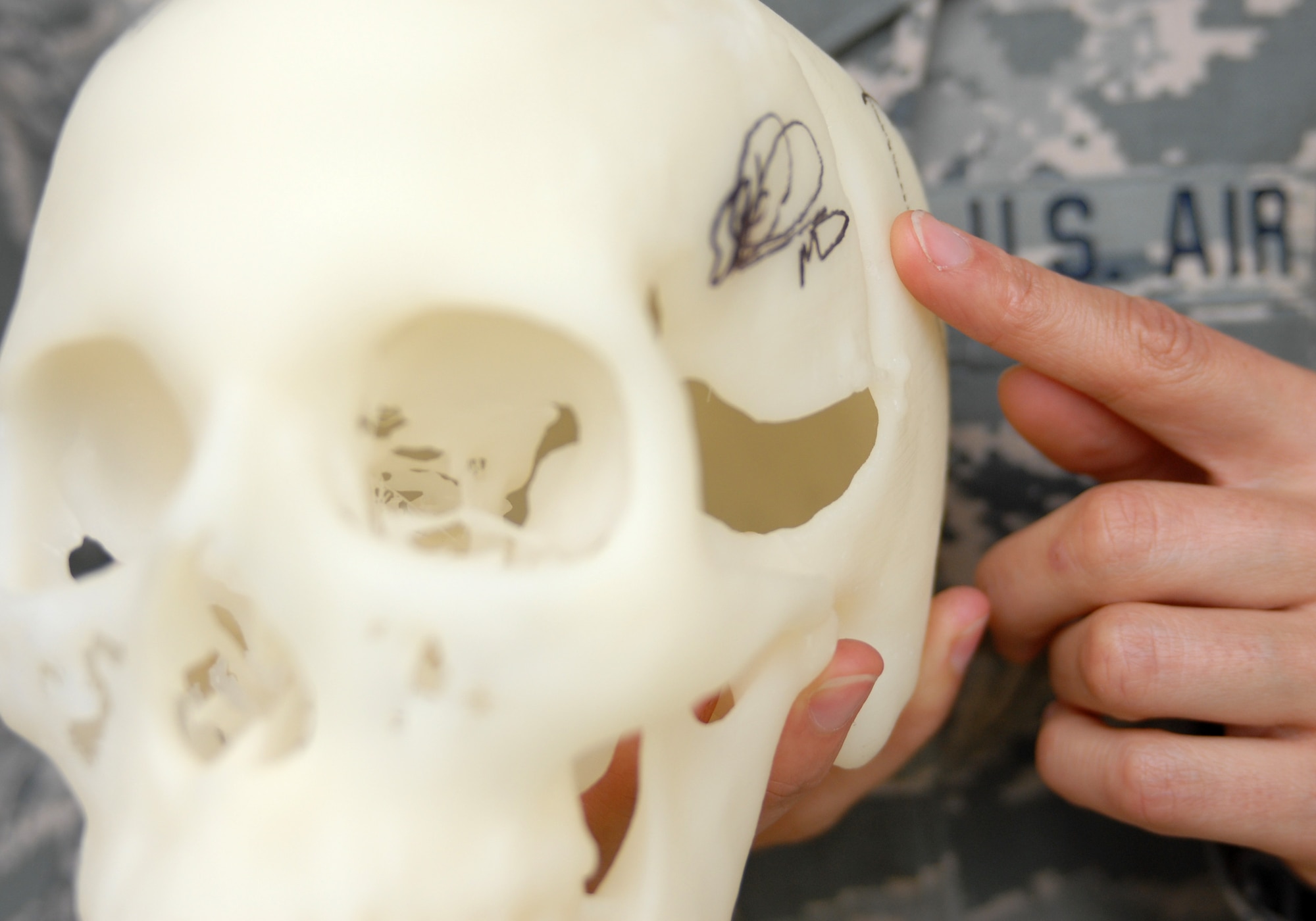 A model of Tech. Sgt. Carmen Colon-Alemany's skull shows where doctors removed a tumor and later a tumor re-growth during two surgeries in 2004 and 2009. The dent in the model shows where her skull didn't fuse properly -- a problem her second surgery fixed. (U.S. Air Force photo/Staff Sgt. Carolyn Viss)