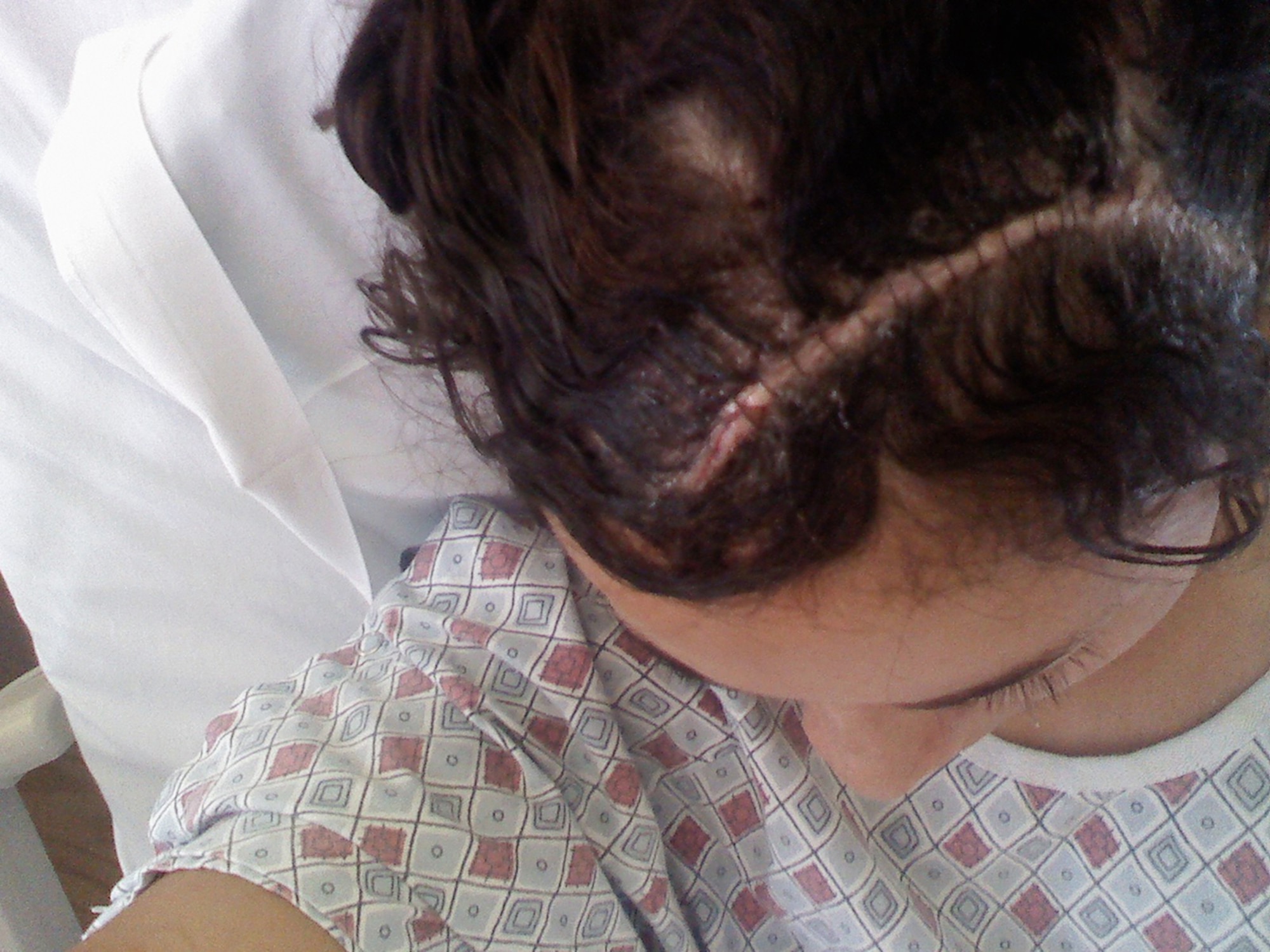 Tech. Sgt. Carmen Colon-Alemany had a huge scar on her head after her first surgery to remove a brain tumor in 2004. (Courtesy photo)