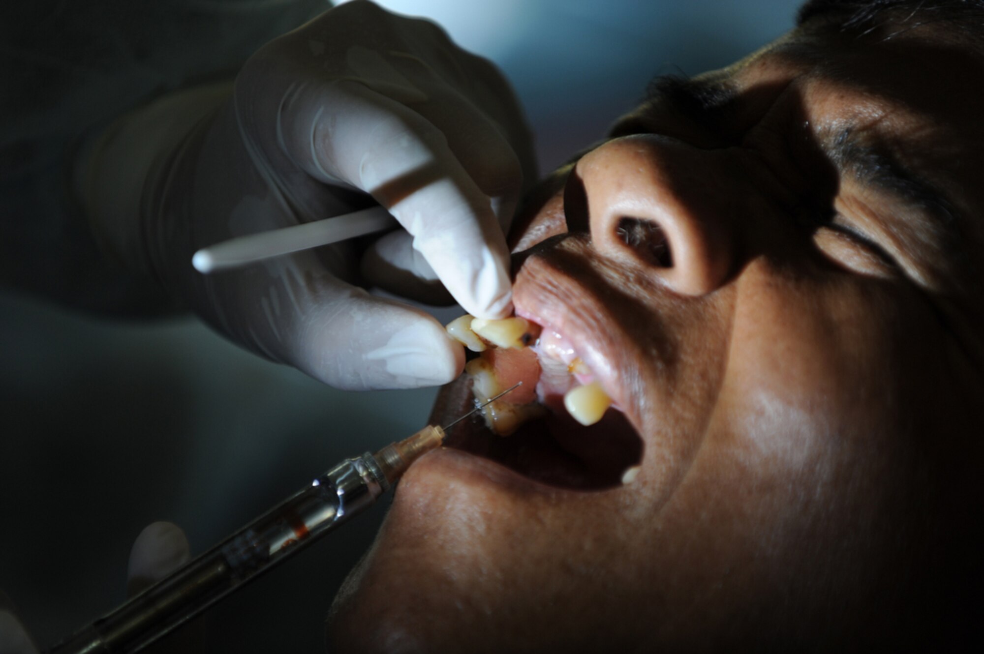 A local Thai man has a tooth extracted by Maj. (Dr.) Kurt Nishiguchi, an Air Force reservist from Joint Base Pearl Harbor Hickam, Hawaii, at the Bau Nong Sroung School in Thailand on March 4.  Airmen from the U.S., Royal Thai and Republic of Singapore air forces teamed up to provide medical, dental and optometry care to local residents as part of Cope Tiger 2010.  Money, school supplies, toys and games were also donated by all three air forces for the children at the school.  (U.S. Air Force photo/Tech Sgt. Cohen A. Young)