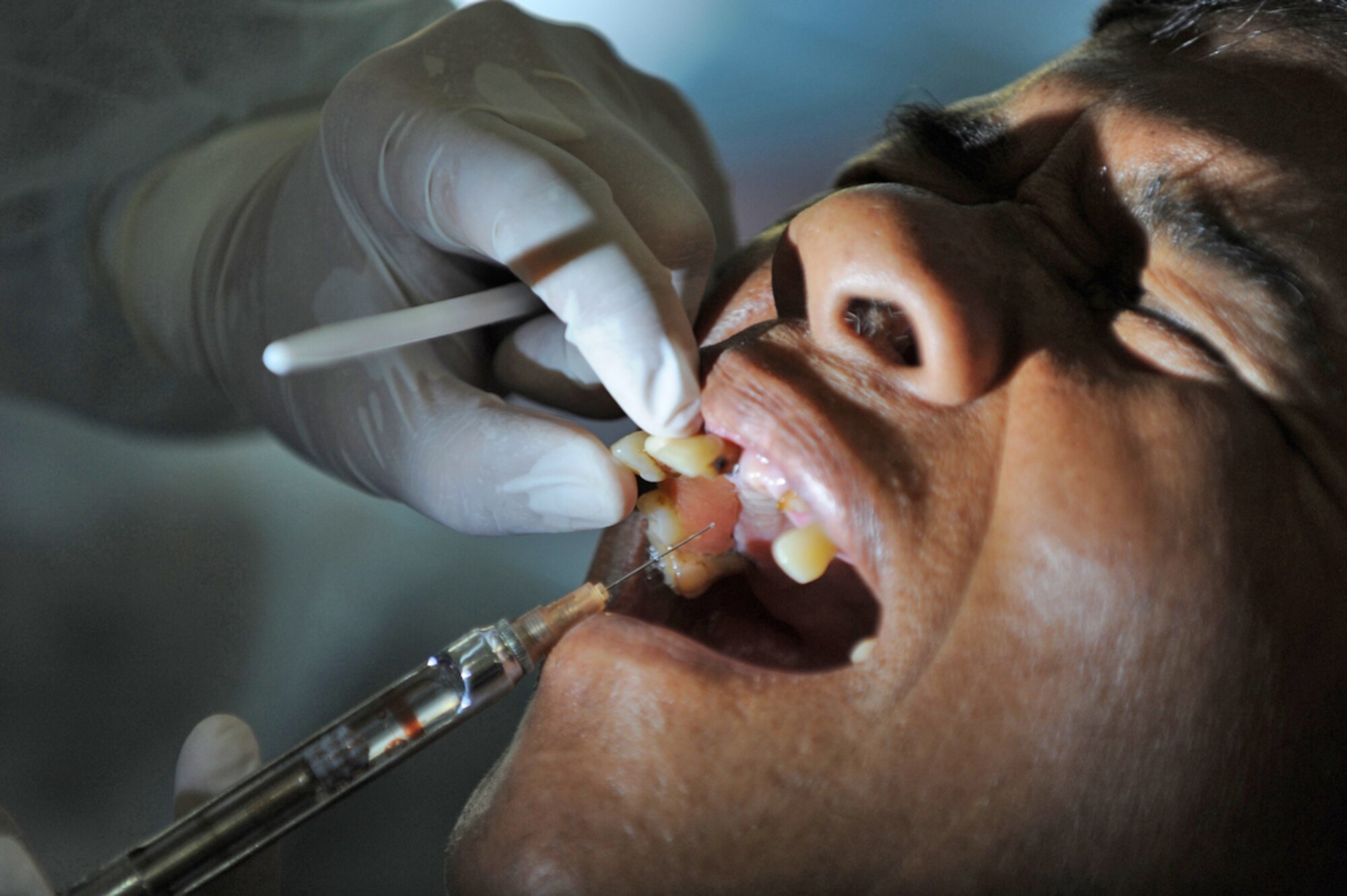 A local man has a tooth extracted by Maj. (Dr.) Kurt Nishiguchi March 4, 2010, at Bau Nong Sroung School in Thailand. Doctor Nishiguchi is an Air Force reservist from Joint Base Pearl Harbor-Hickam, Hawaii. (U.S. Air Force photo/Tech. Sgt. Cohen A. Young)