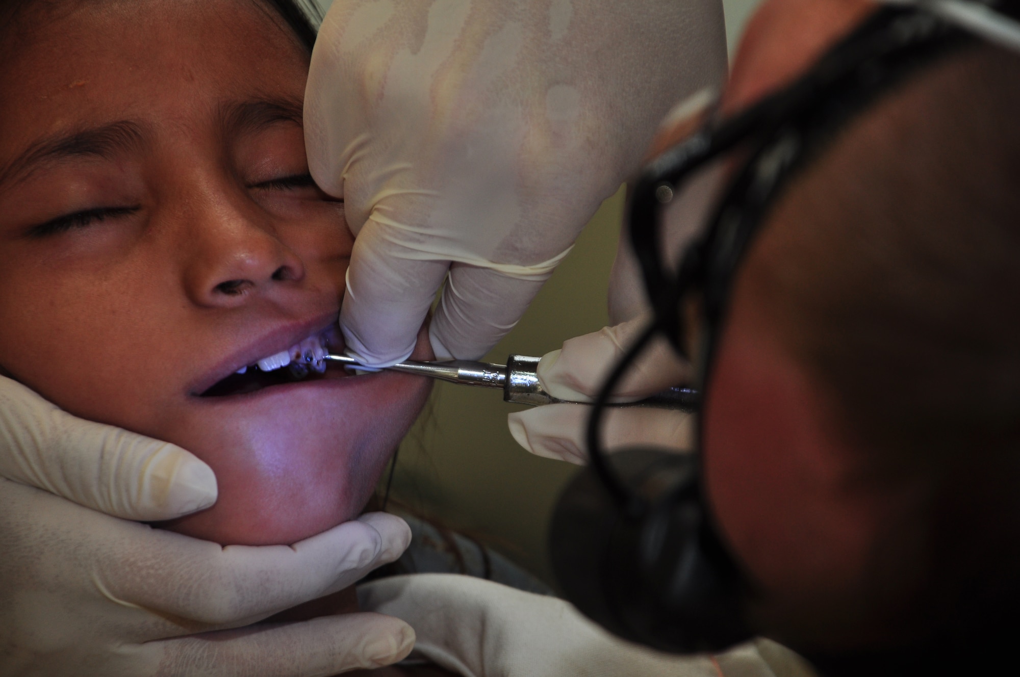 A dentist with the Joint Task Force-Bravo medical readiness training exercise mission to Belize elevates a tooth from the gum line before extracting the tooth March 3. The JTF-Bravo medical readiness training exercise team in conjunction with members from the Belize Ministry of Health and the Belize Defense Force provided medical care to more than 630 people from the villages of St. Margaret’s and Armenia March 1-4. (U.S. Air Force Photo/Staff Sgt. Bryan Franks)