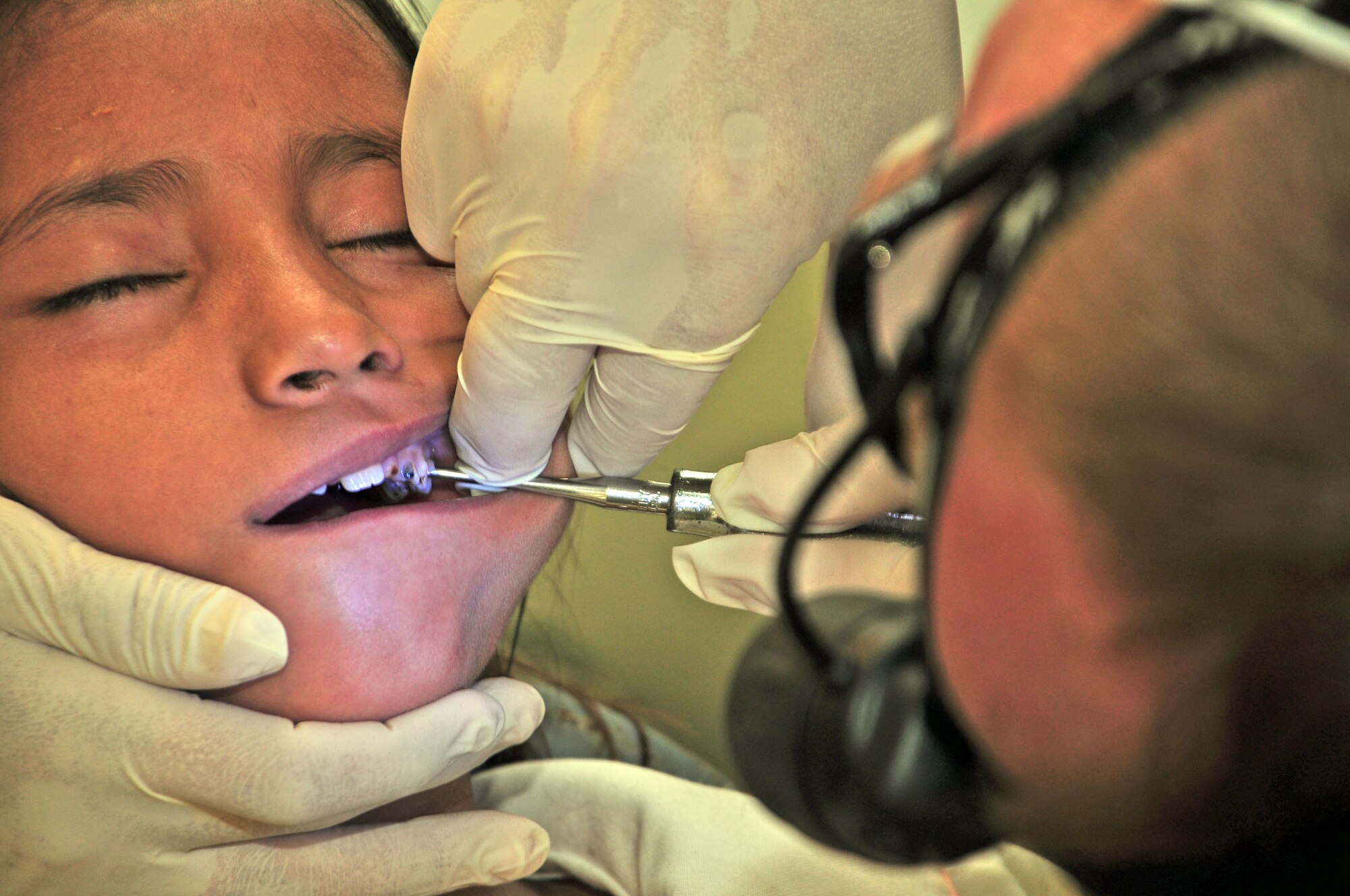 A dentist with the Joint Task Force-Bravo medical readiness training exercise mission to Belize elevates a tooth from the gum line before extracting the tooth March 3, 2010, in Belize. The JTF-Bravo medical readiness training exercise team in conjunction with members from the Belize ministry of health and the Belize defense force provided medical care to more than 630 people from the villages of St. Margaret's and Armenia March 1 through 4. (U.S. Air Force photo/Staff Sgt. Bryan Franks)