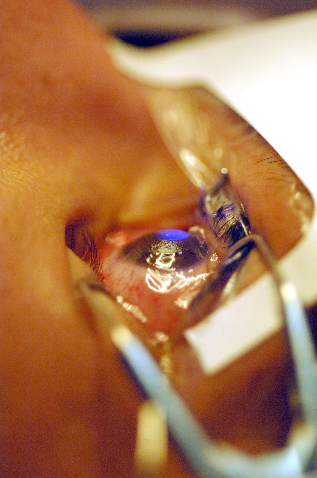 A refractive surgery laser shines blue on a patient's cornea as it corrects their vision on Nov. 3, 2010. Laser-assisted refractive surgeries are common practice at the Joint Warfighter Refractive Surgery Center, Lackland Air Force Base, Texas.   (U.S. Air Force photo by Staff Sgt. Robert Barnett)
