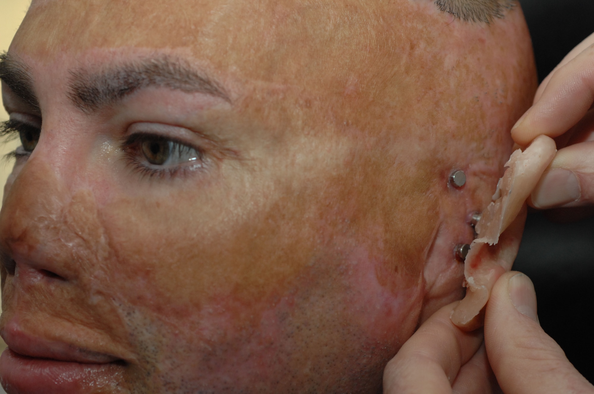 U.S. Army Staff Sgt. (Ret.) Shilo Harris is fitted for prosthetic ears at the dental clinic on Joint Base San Antonio, Lackland.  A wax model of the ear is first molded to ensure proper placement and fit before applying the prosthetic. The Maxillofacial Prosthetics Department at Wilford Hall Ambulatory Surgical Center employs a team that deals with the rehabilitation of patients with acquired and congenital defects of the head and neck region. They are one of only a few in the Department of Defense that creates prosthetic body parts, such as eyes, ears and noses. (U.S. Air Force photo /Staff Sgt. Robert Barnett)  