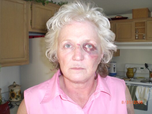 Ms. Shawn Mayo, from the 92nd Air Refueling Wing at Fairchild Air Force Base, Wash., is pictured on Sept. 13, 2008, two days after she lost focus of the road half a block away from her home in Medical Lake, Wash. It took one month for the bruises and scars on her face to disappear. She still has residual effects from her accident. She experinces chronic back pain, muscle and joint aches. Occassionally, she visits the visits the doctor for medicinal physical therapy. (Courtesy Photo)