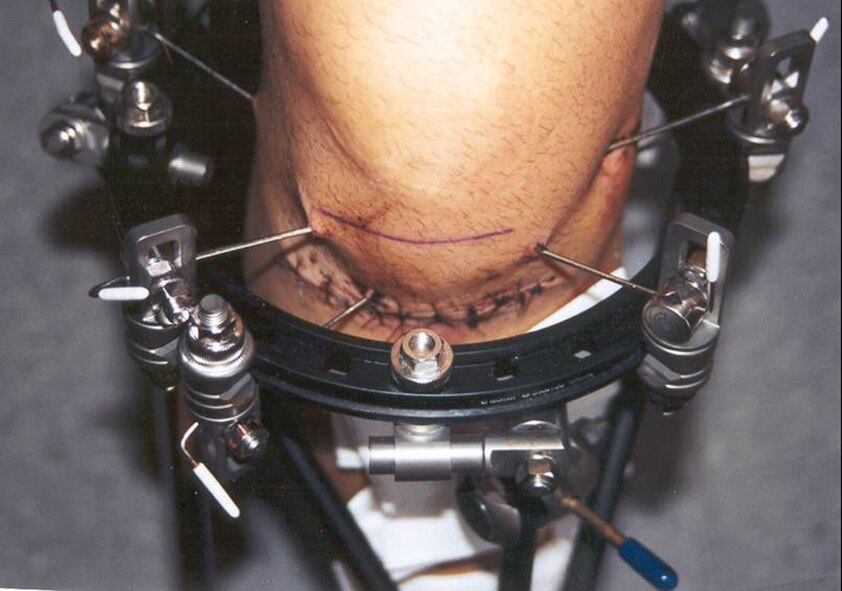 A WILD RIDE - Doctors twice threatened to amputate Bilancia’s right leg — once after he shattered his knee and broke his tibia and fibula in the 2002 motorcycle mishap, and then again in 2008 when he developed sepsis in the knee. Here, an external stabilizer holds three pins through his knee and two screws in his tibia to help his leg heal after the crash.
(Photo Courtesy of Matt Bilancia)