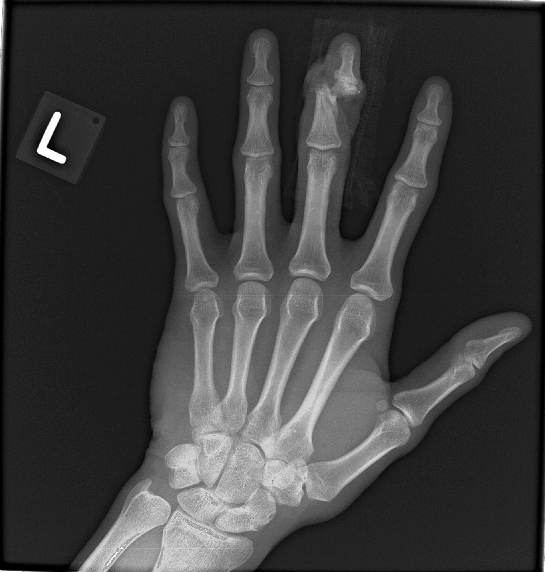 An X-ray of Airman 1st Class Daniel Cherry's left hand depicts where his middle finger was nearly sliced in two by a 4,000 pound pallet. Cherry, a C-17 Globemaster III loadmaster deployed from Charleston Air Force Base, S.C., was loading cargo onto an aircraft when his finger became stuck on a D-ring and was nearly amputated between a pallet and loading rail. (courtesy photo)